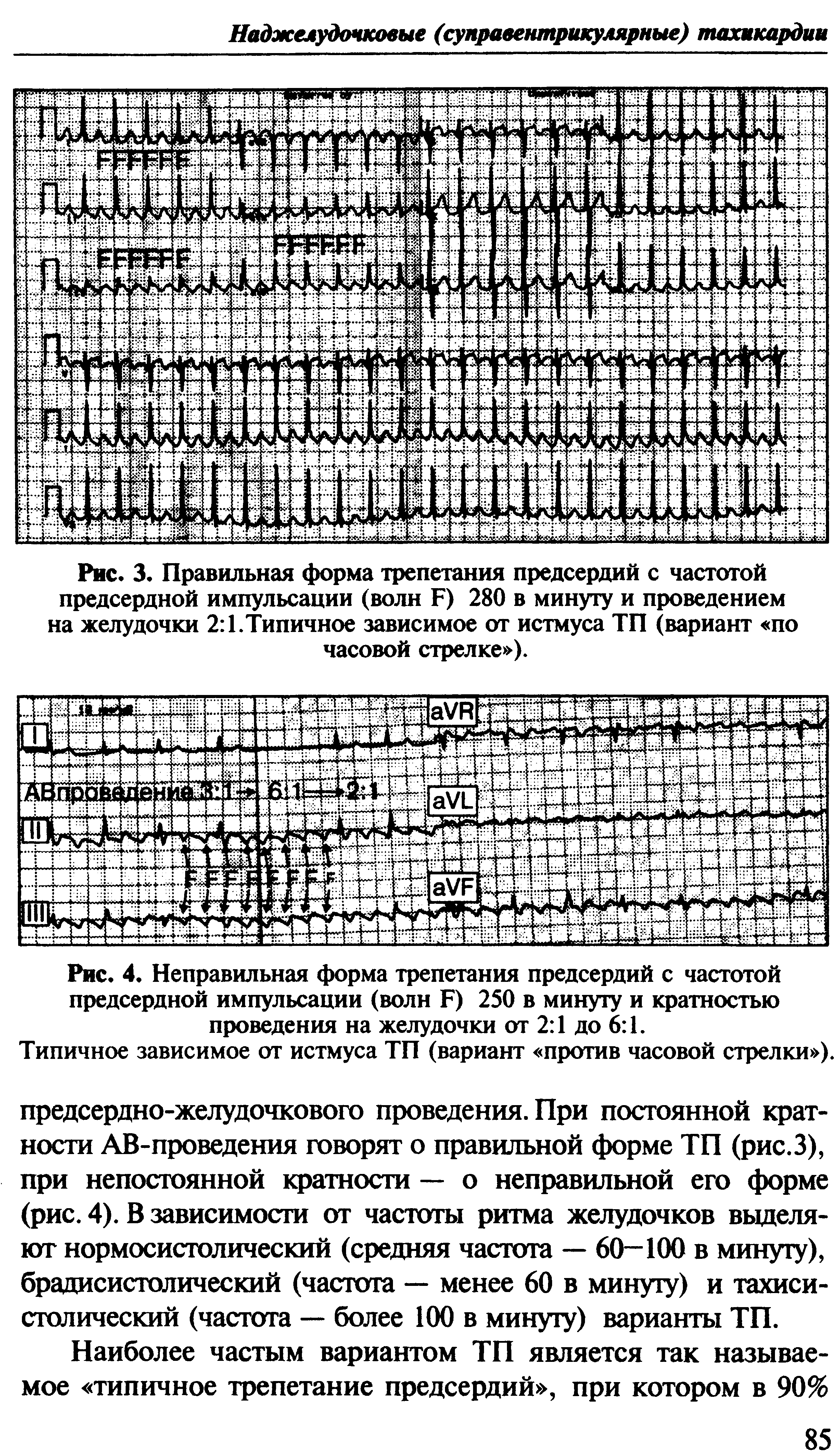 Рис. 3. Правильная форма трепетания предсердий с частотой предсердной импульсации (волн Б) 280 в минуту и проведением на желудочки 2 .Типичное зависимое от истмуса ТП (вариант по часовой стрелке ).