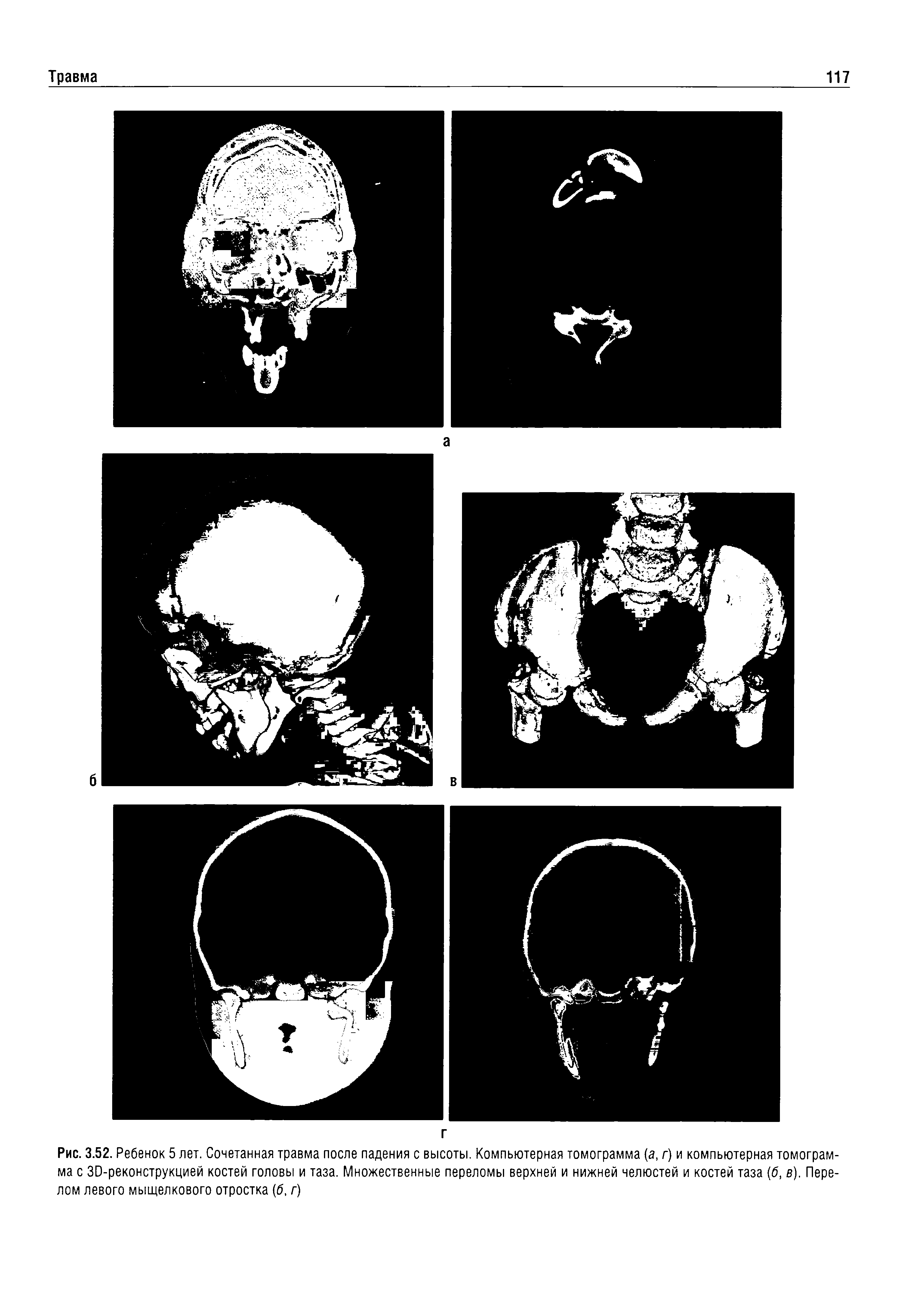 Рис. 3.52. Ребенок 5 лет. Сочетанная травма после падения с высоты. Компьютерная томограмма (а, г) и компьютерная томограмма с ЗО-реконструкцией костей головы и таза. Множественные переломы верхней и нижней челюстей и костей таза (б, в). Перелом левого мыщелкового отростка (б, г)...