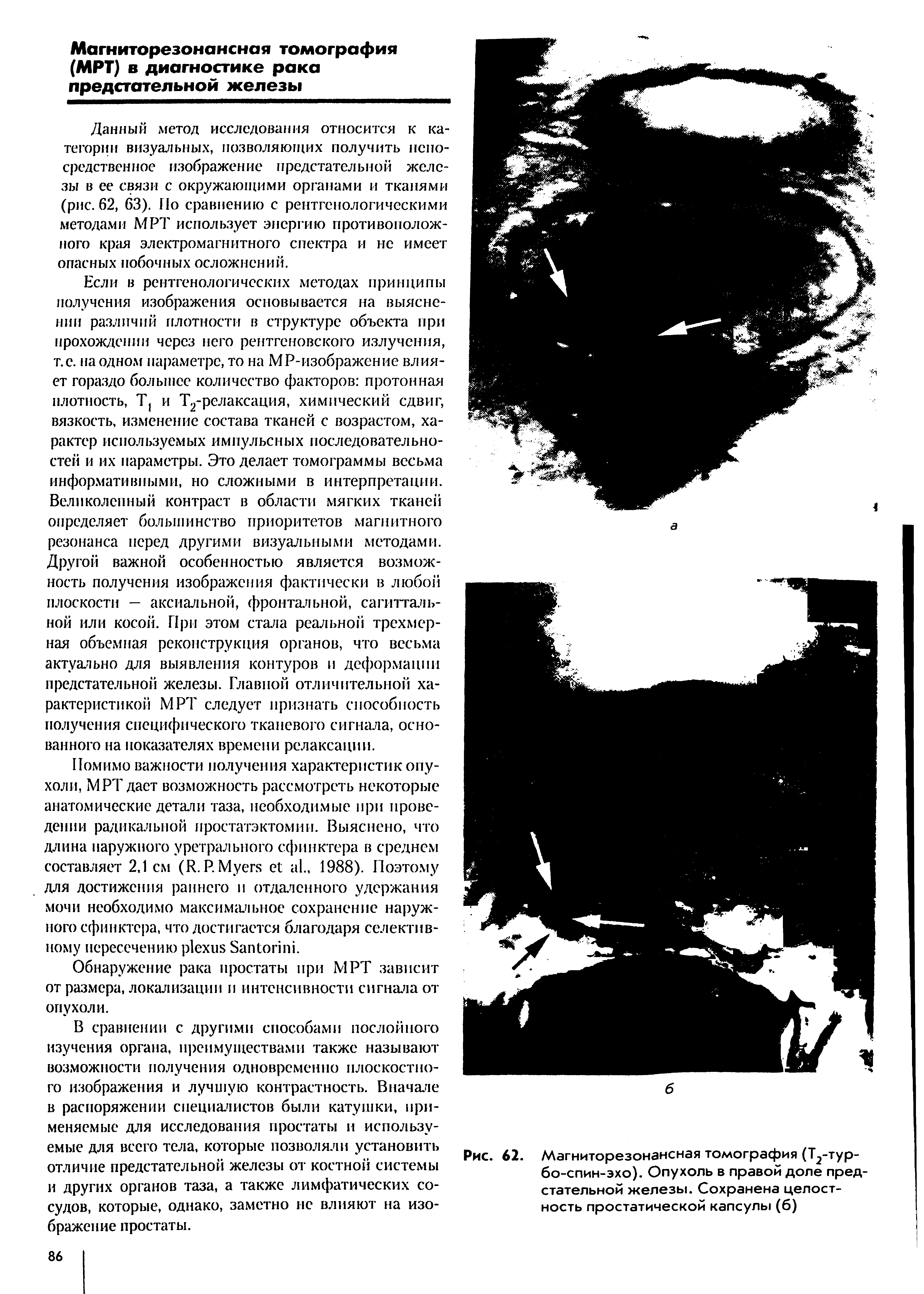 Рис. 62. Магниторезонансная томография (Т -тур-бо-спин-эхо). Опухоль в правой доле предстательной железы. Сохранена целостность простатической капсулы (б)...