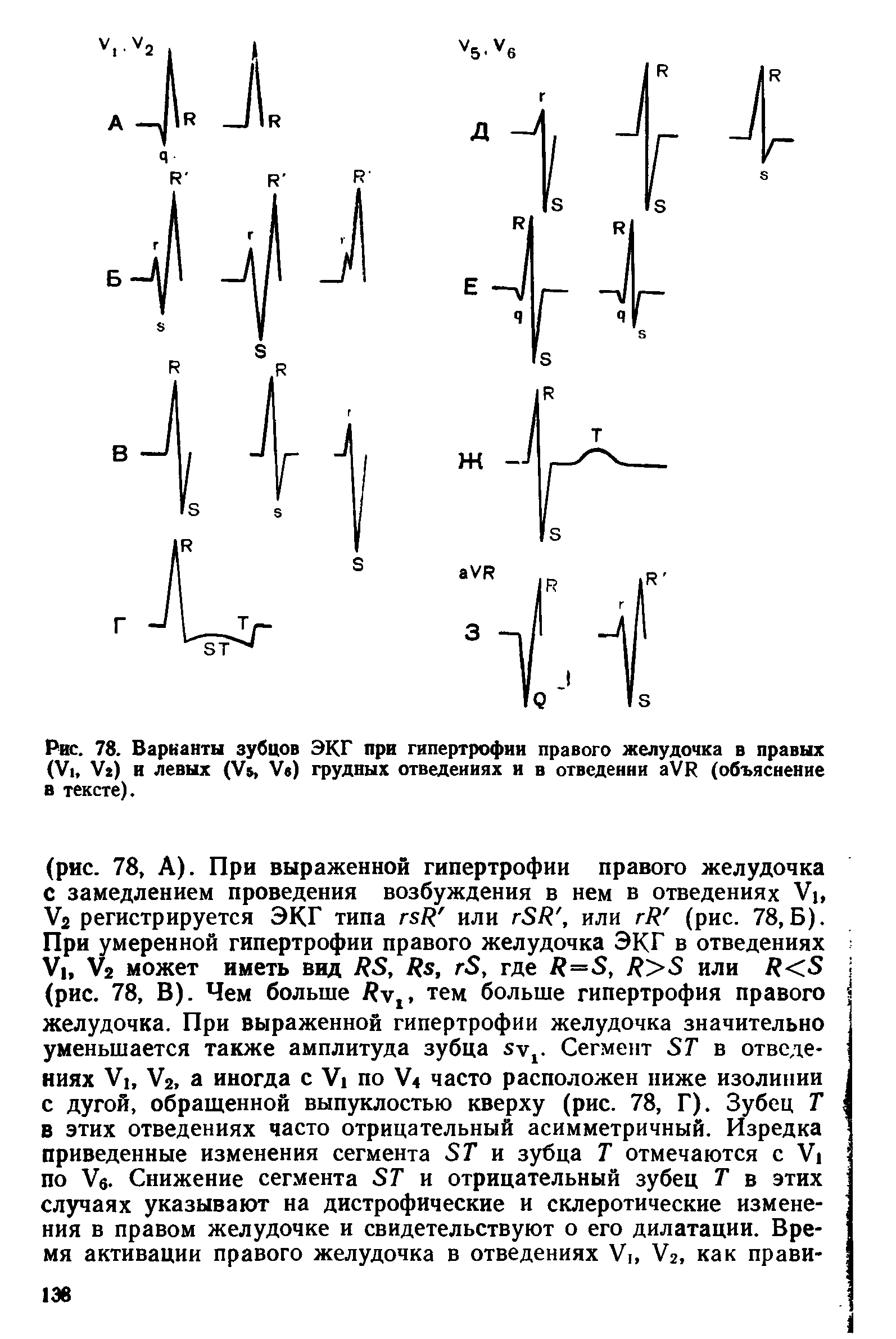 Рис. 78. Варианты зубцов ЭКГ при гипертрофии правого желудочка в правых (У1, У ) и левых (У, V ) грудных отведениях и в отведении аУ (объяснение в тексте).