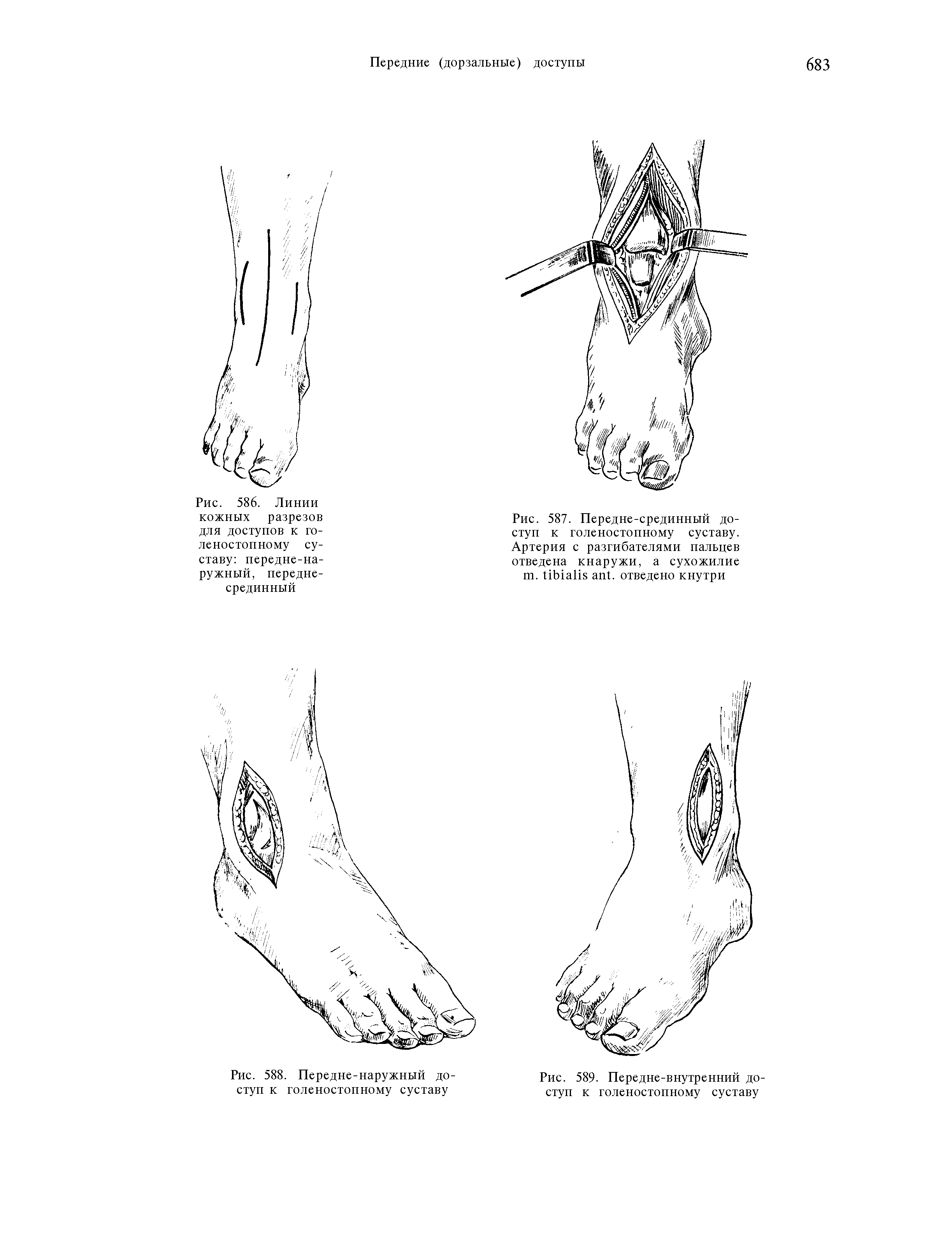 Рис. 586. Линии кожных разрезов для доступов к голеностопному суставу передне-наружный, переднесрединный...