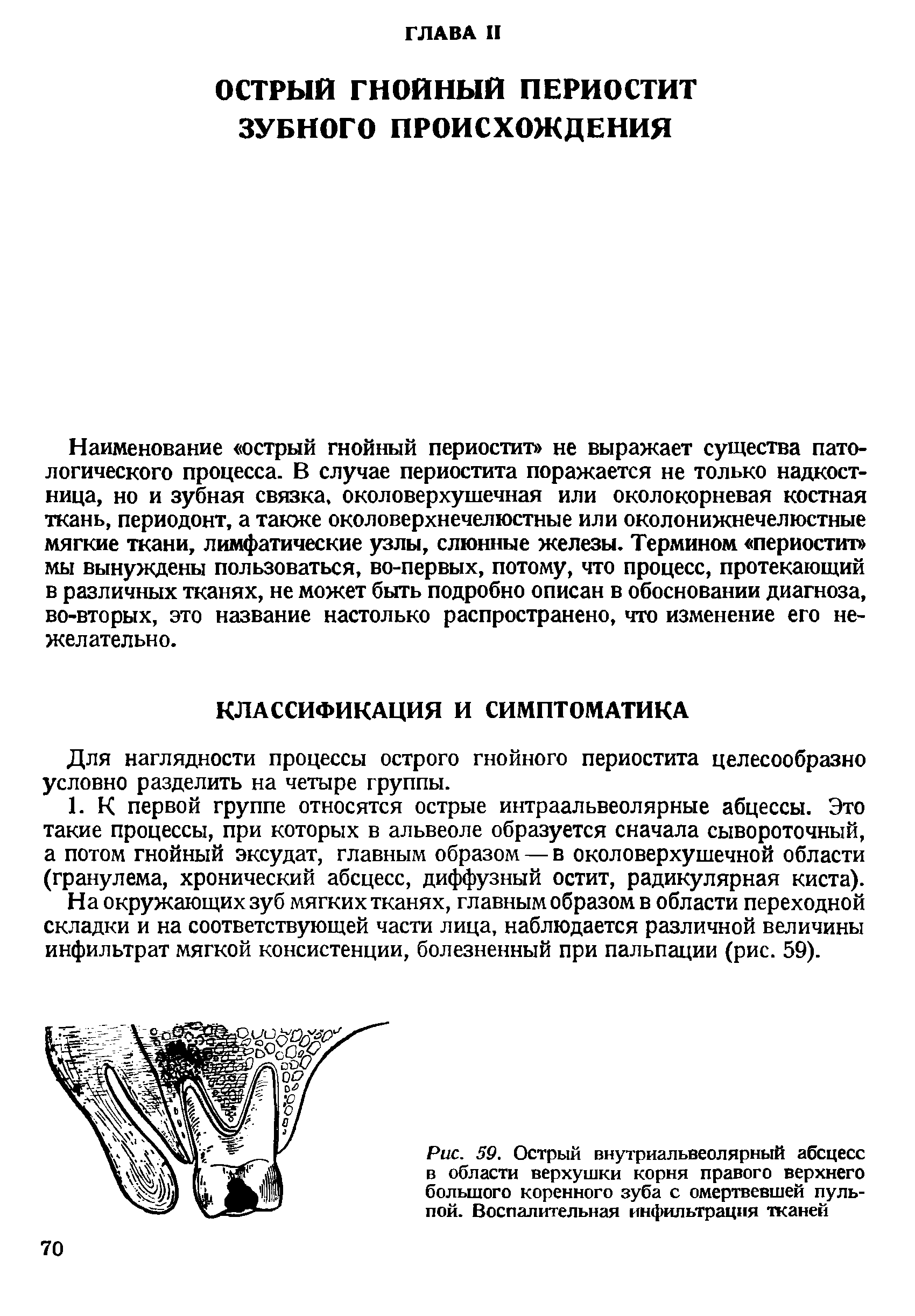 Рис. 59. Острый внутриальвеолярный абсцесс в области верхушки корня правого верхнего большого коренного зуба с омертвевшей пульпой. Воспалительная инфильтрация тканей...