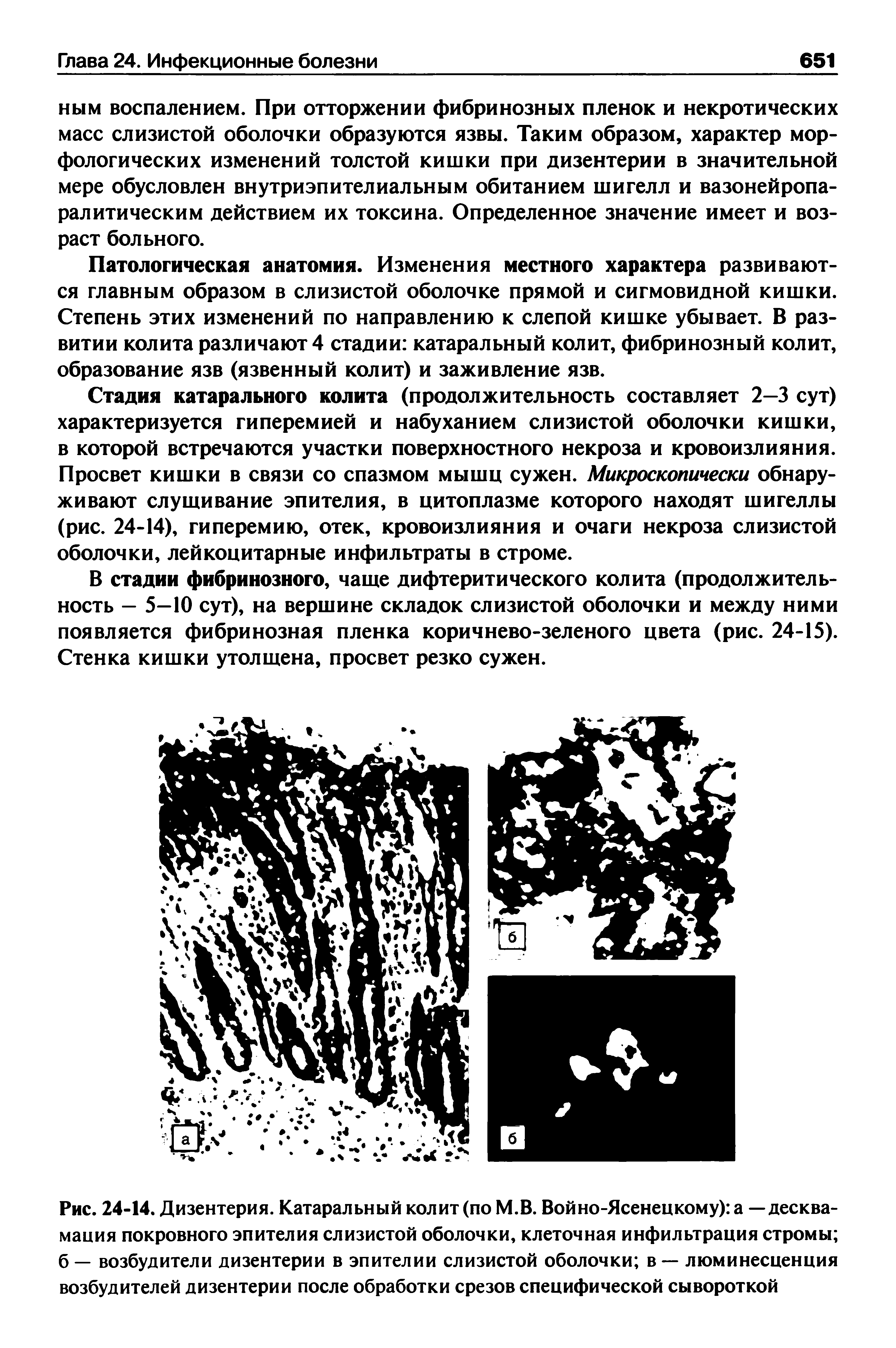 Рис. 24-14. Дизентерия. Катаральный колит (по М.В. Войно-Ясенецкому) а —десква-мация покровного эпителия слизистой оболочки, клеточная инфильтрация стромы б — возбудители дизентерии в эпителии слизистой оболочки в — люминесценция возбудителей дизентерии после обработки срезов специфической сывороткой...