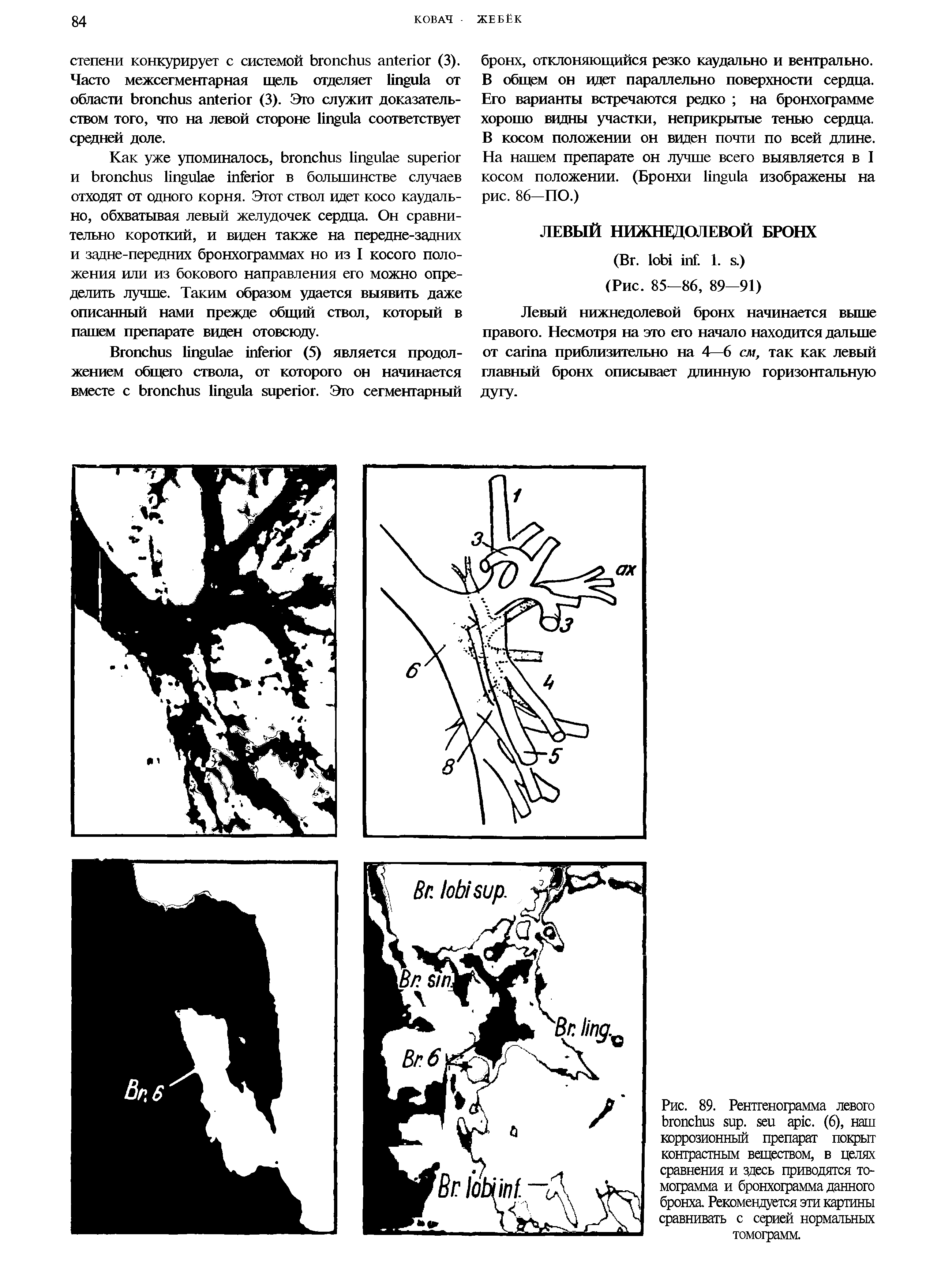 Рис. 89. Рентгенограмма левого . . (6), наш коррозионный препарат покрыт контрастным веществом, в целях сравнения и здесь приводятся томограмма и бронхограмма данного бронха. Рекомендуется эти картины сравнивать с серией нормальных томограмм.