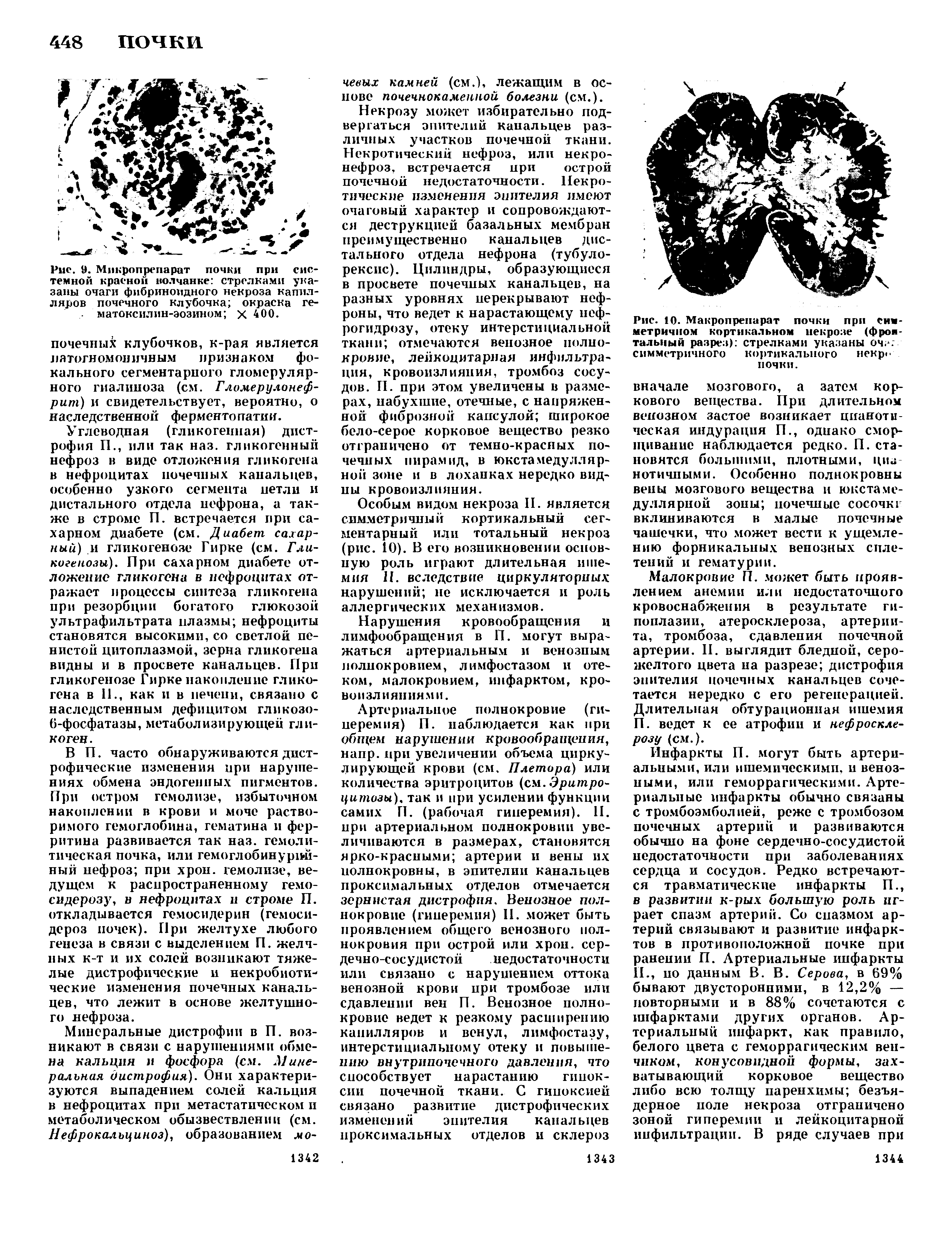 Рис. 9. Микропрспарат почки при системной красной волчанке стрелками указаны очаги фибриноидного некроза капилляров почечного клубочка окраска ге-матоксилин-эозином х 400.