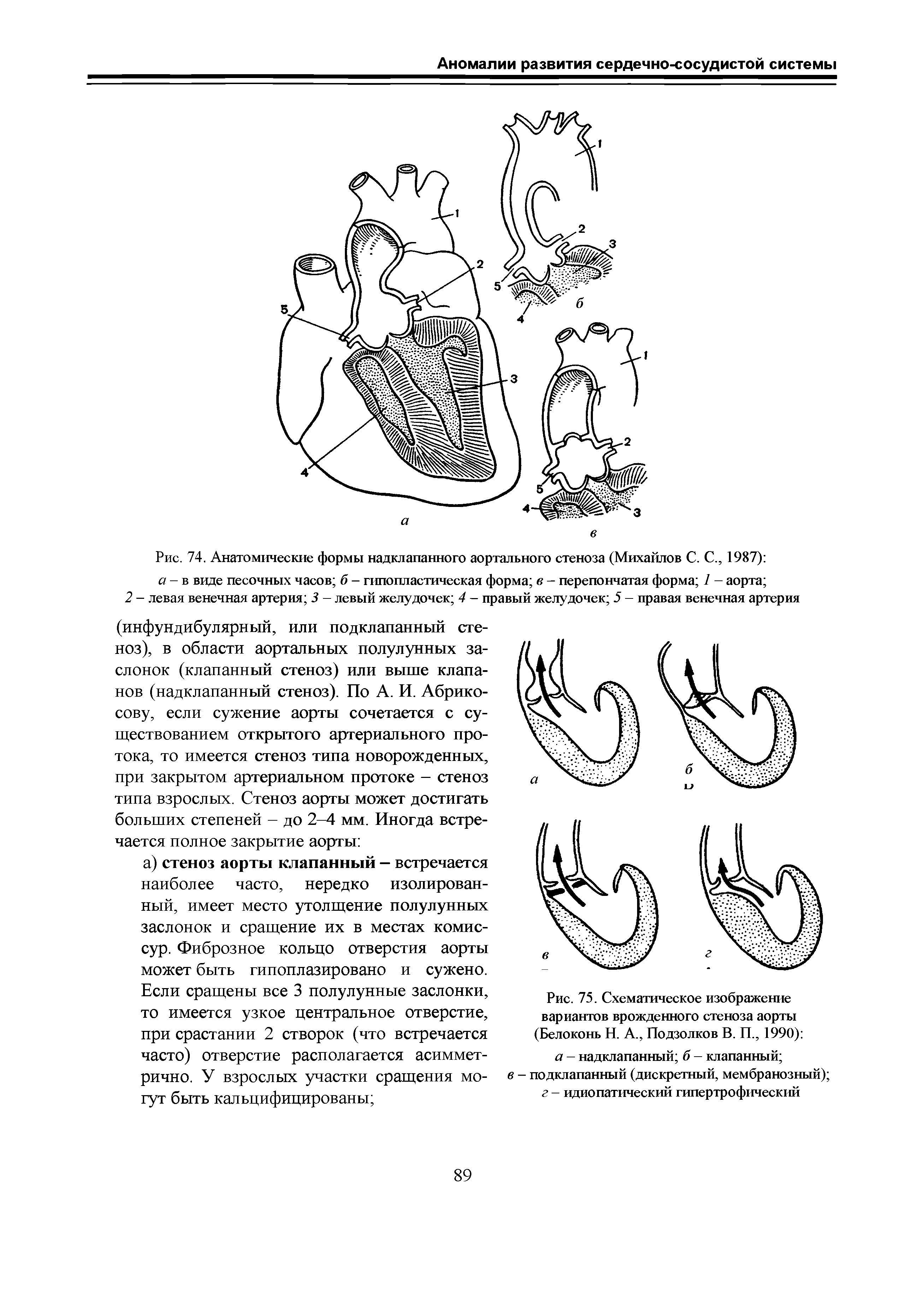 Рис. 75. Схематическое изображение вариантов врожденного стеноза аорты (Белоконь Н. А., Подзолков В. П., 1990) а - надклапанный б — клапанный в - подклапанный (дискретный, мембранозный) г - идиопатический гипертрофический...