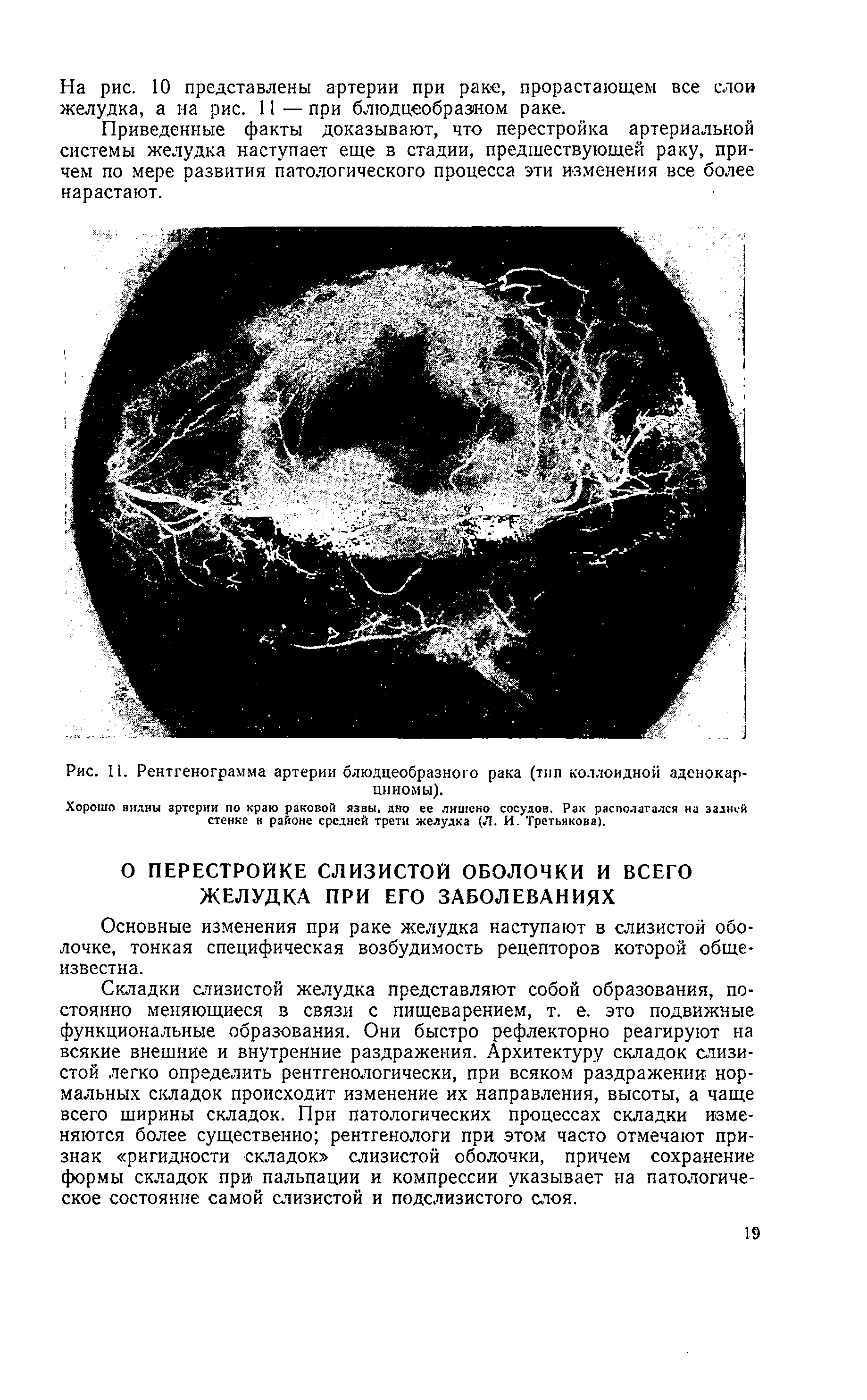 Рис. II. Рентгенограмма артерии блю.вдеобразного рака (тип коллоидной аденокарциномы).