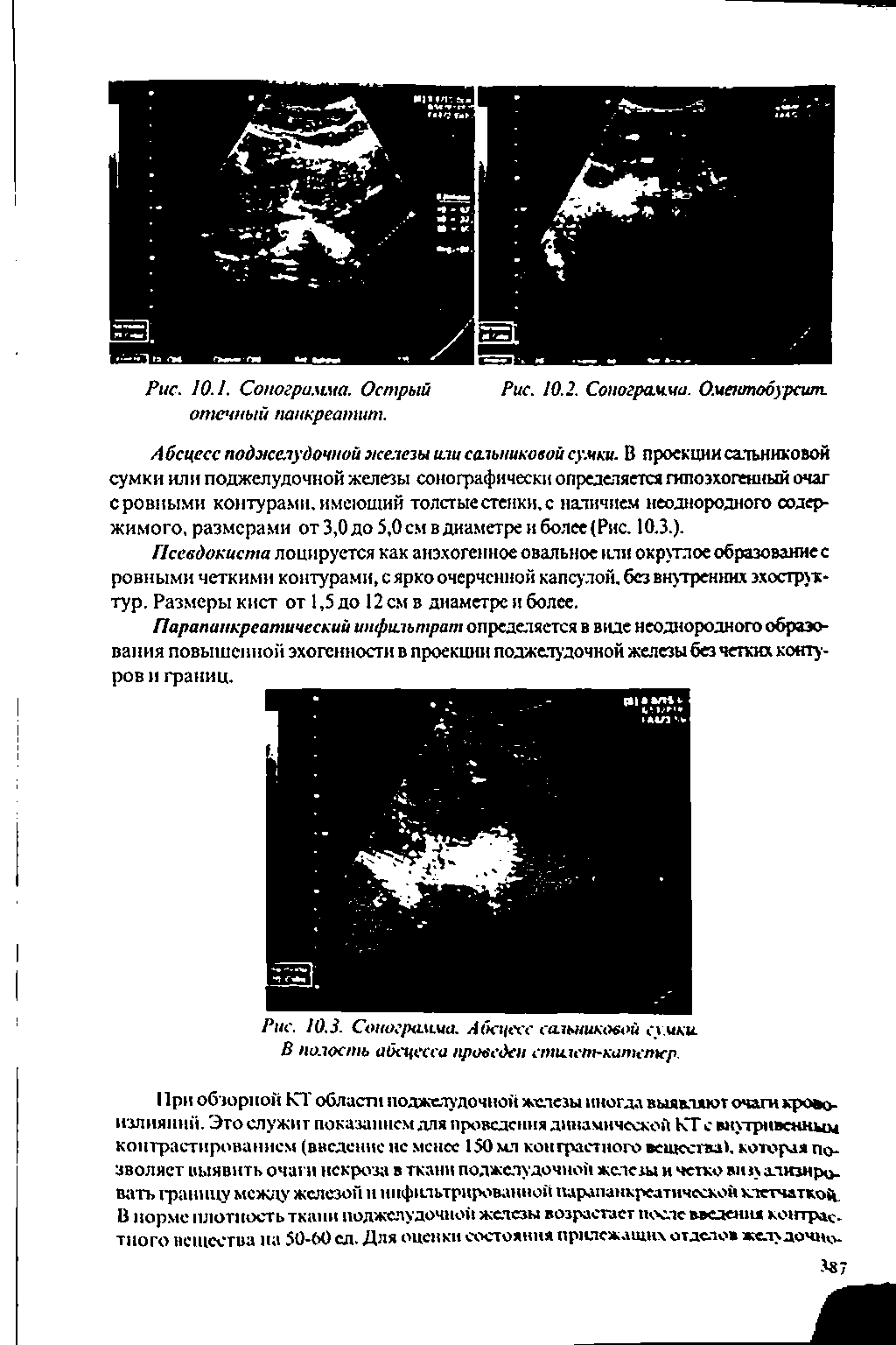 Рис. 10.3. Сонограмма. Абсцесс сальниковой сумки. В полость абсцесса проведен стилет-катетер.