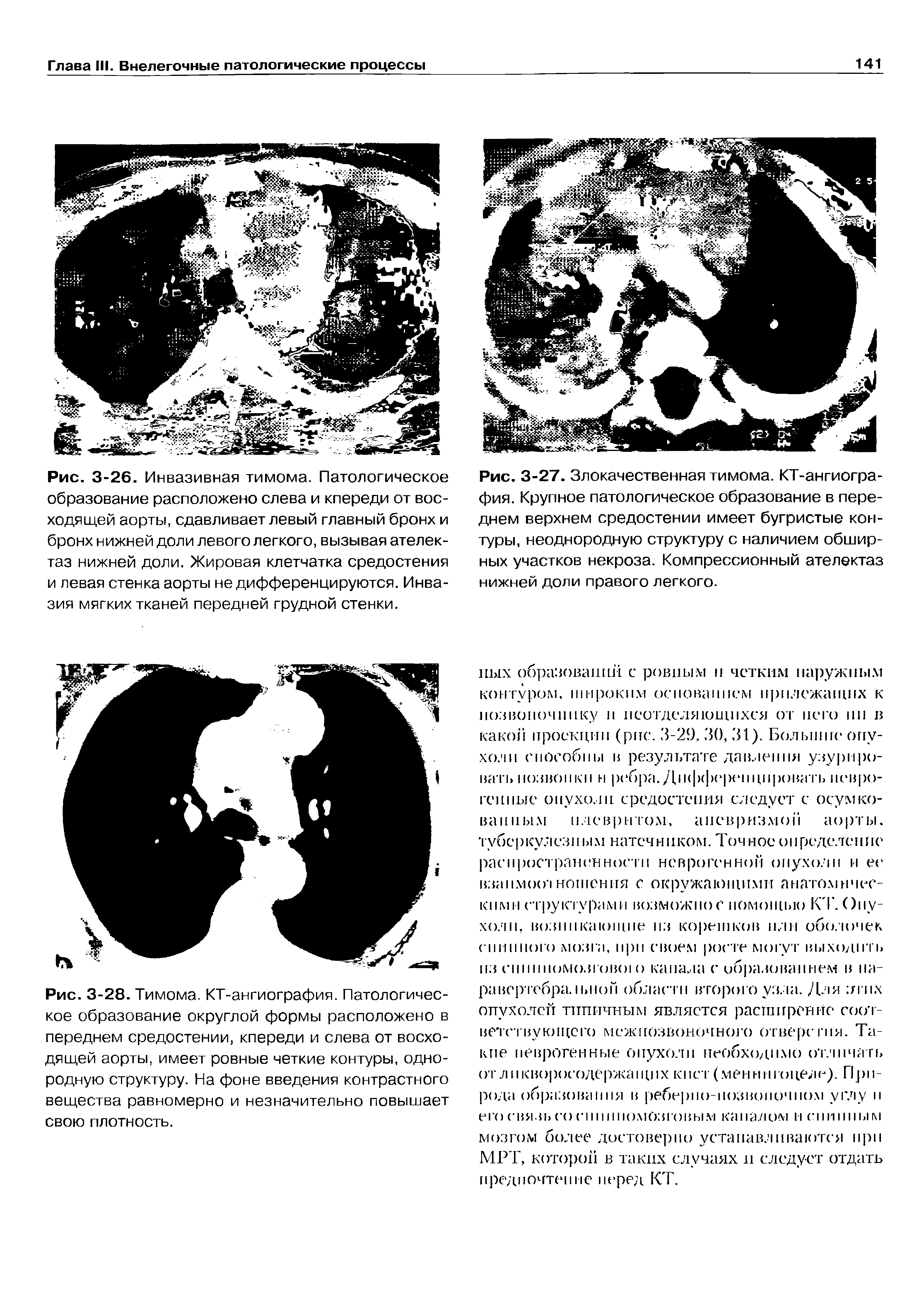 Рис. 3-28. Тимома. КТ-ангиография. Патологическое образование округлой формы расположено в переднем средостении, кпереди и слева от восходящей аорты, имеет ровные четкие контуры, однородную структуру. На фоне введения контрастного вещества равномерно и незначительно повышает свою плотность.