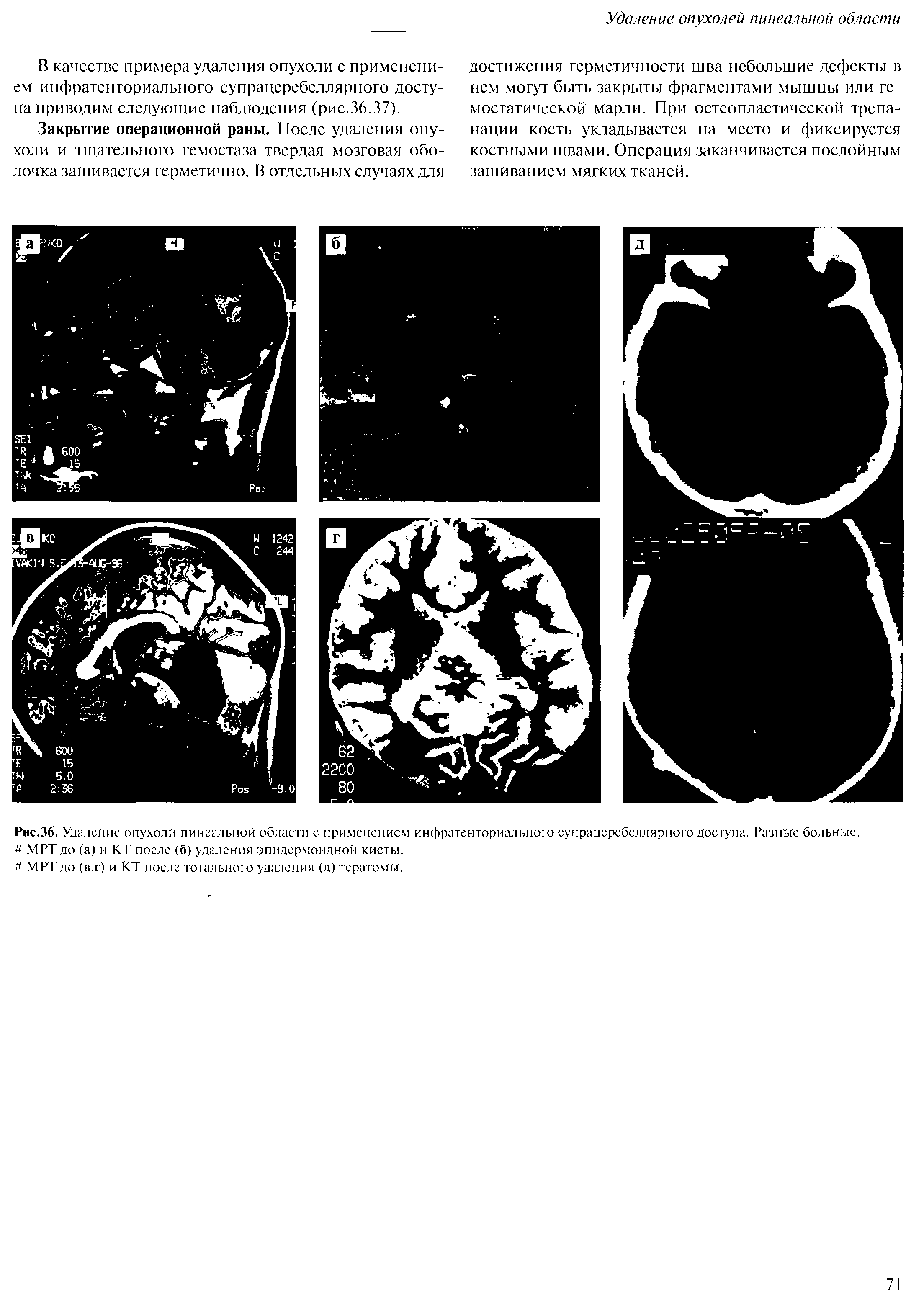 Рис.36. Удаление опухоли пинеальной области с применением инфратенториального супрацеребеллярного доступа. Разные больные. MPT до (а) и КТ после (б) удаления эпидермоидной кисты.