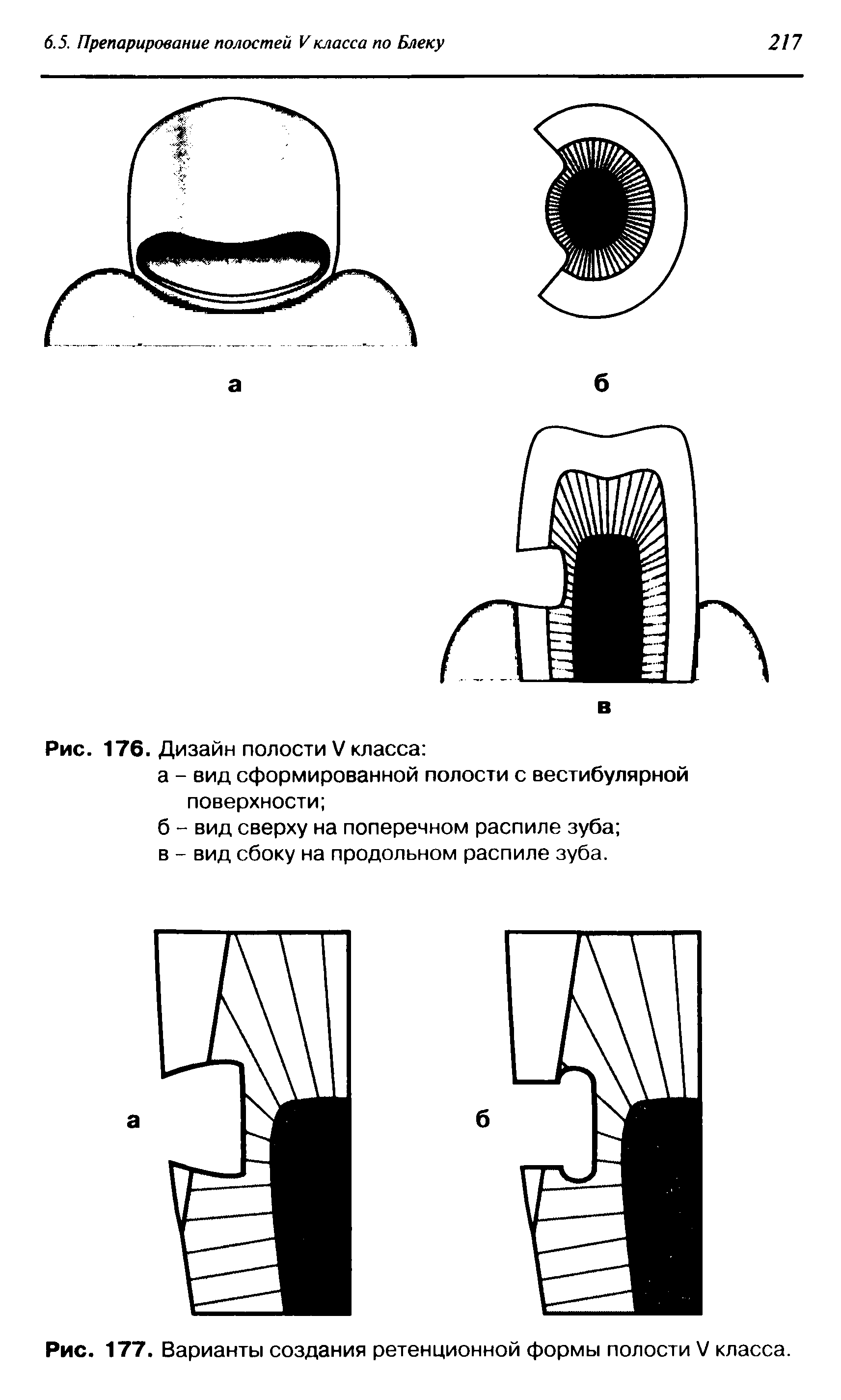Рис. 177. Варианты создания ретенционной формы полости V класса.