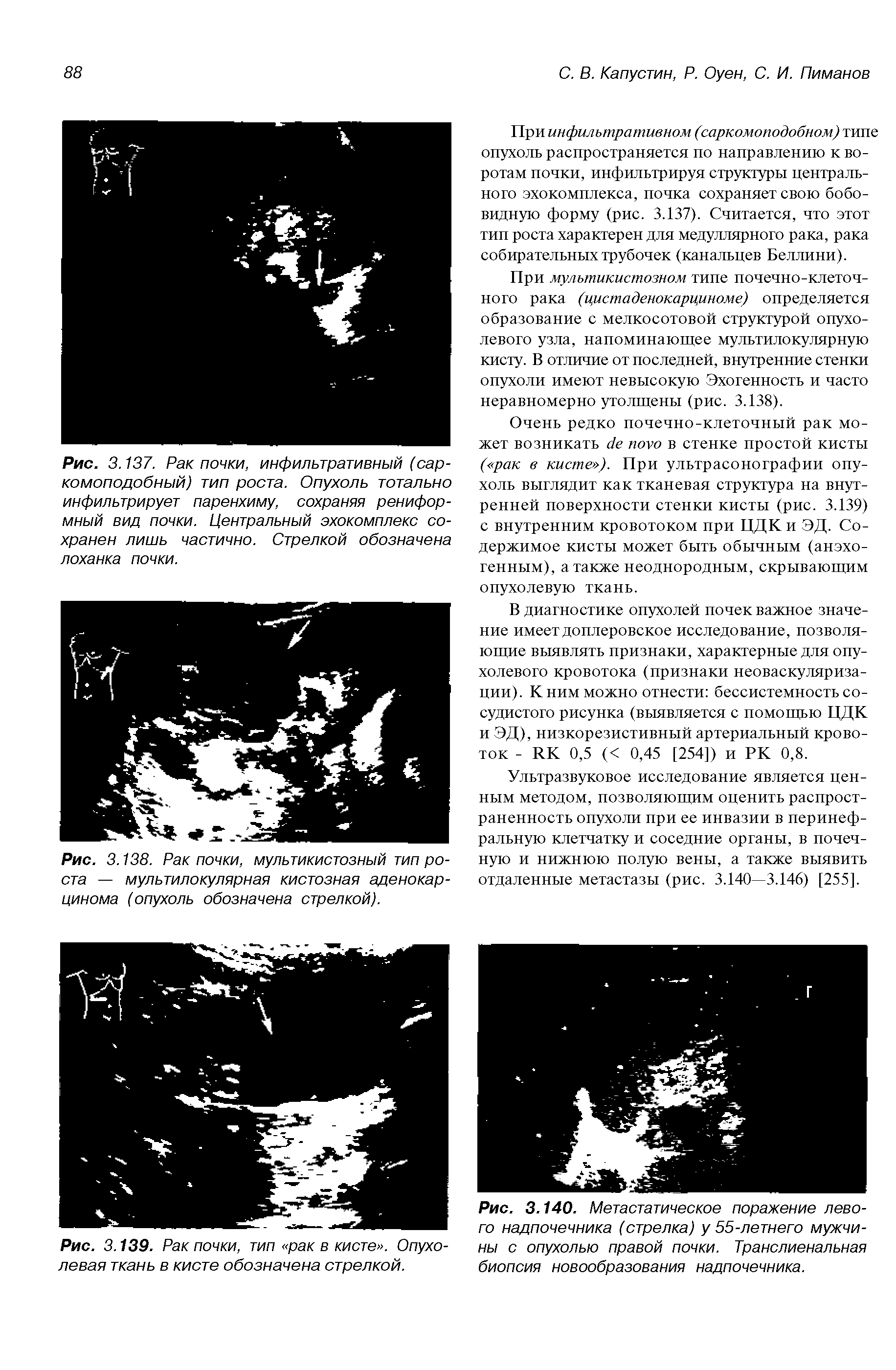 Рис. 3.138. Рак почки, мультикистозный тип роста — мультилокулярная кистозная аденокарцинома (опухоль обозначена стрелкой).