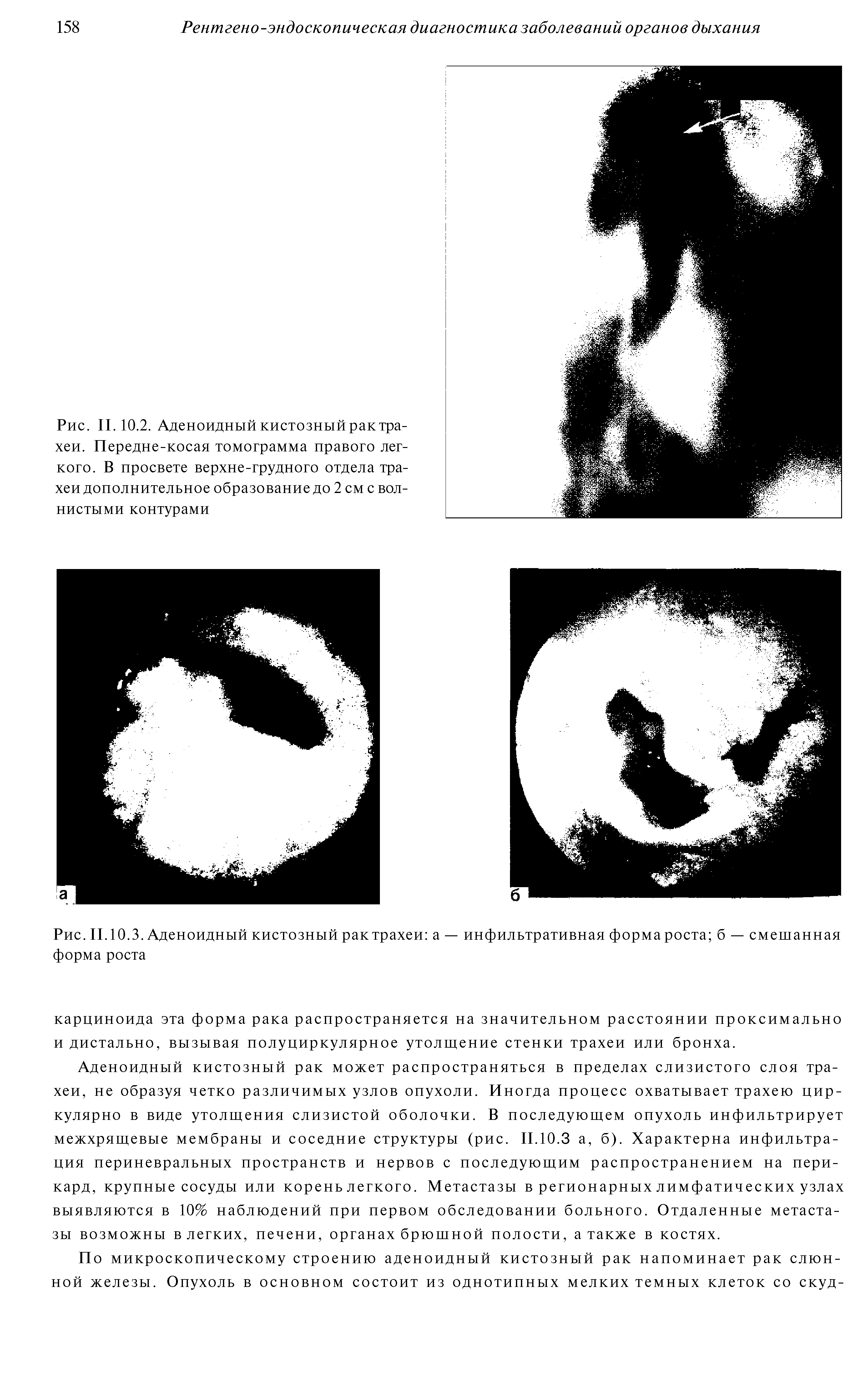 Рис. II. 10.2. Аденоидный кистозный рак трахеи. Передне-косая томограмма правого легкого. В просвете верхне-грудного отдела трахеи дополнительное образование до 2 см с волнистыми контурами...