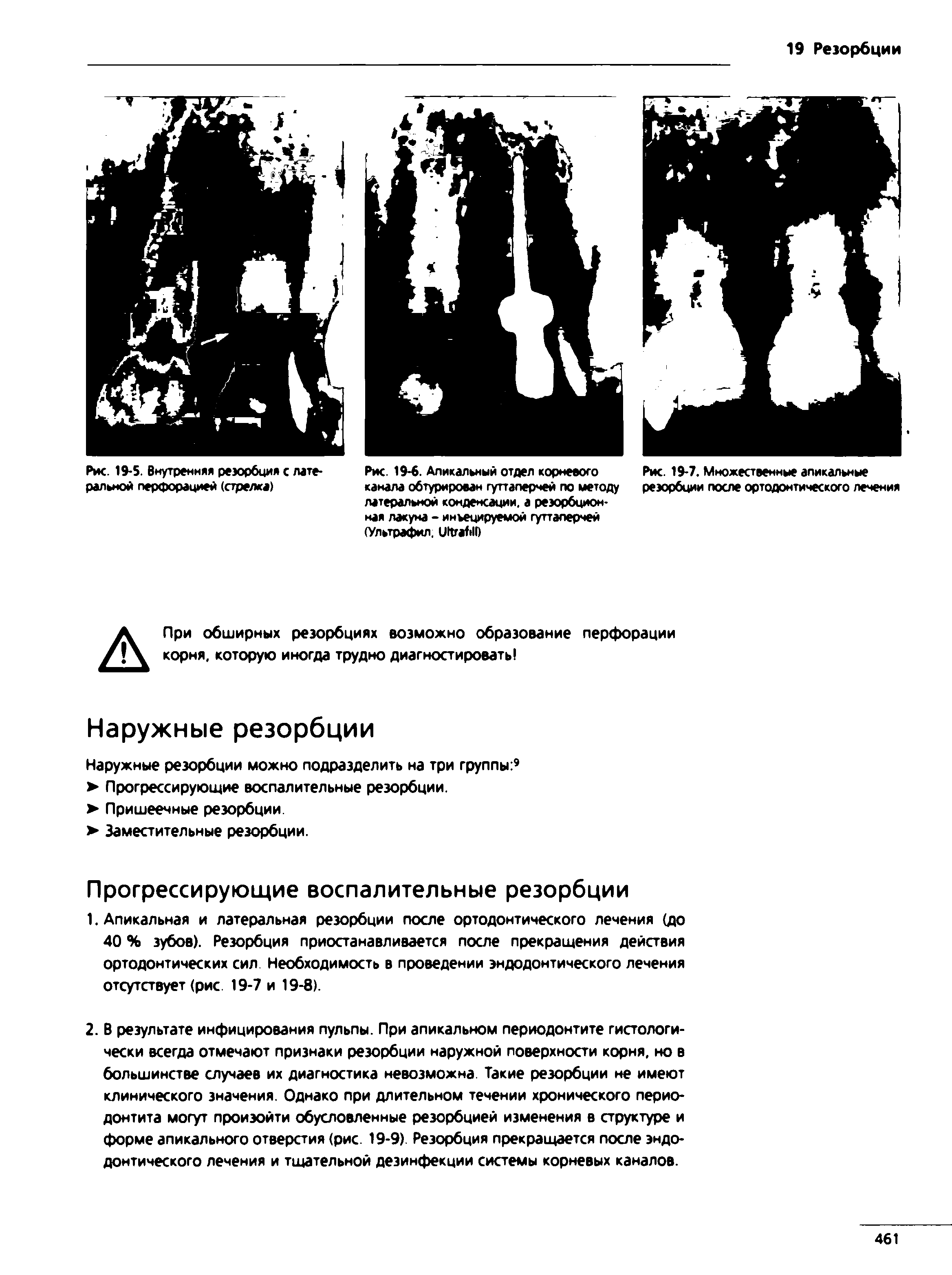 Рис. 19-7. Множественные апикальные резорбции после ортодонтического лечения...