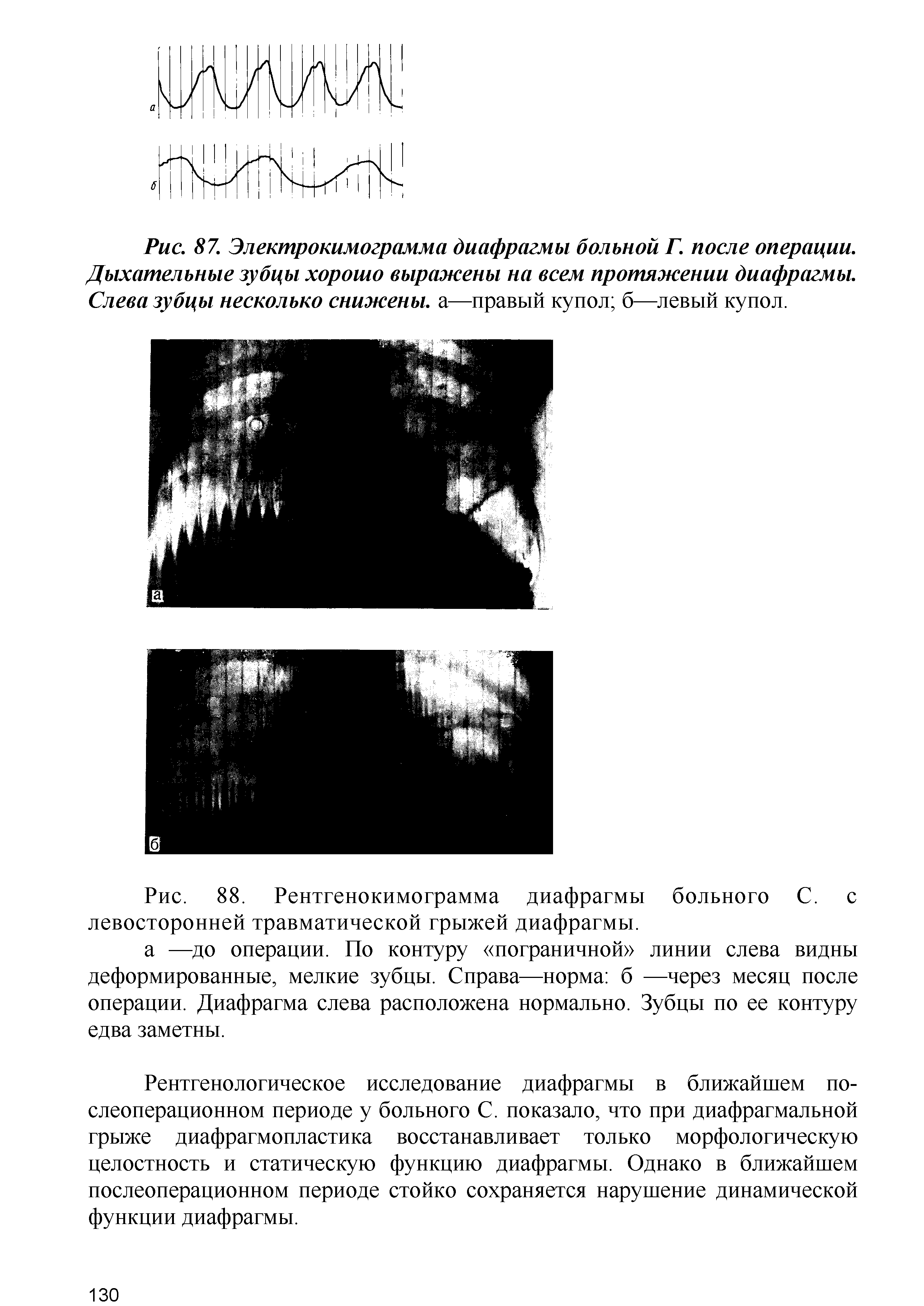 Рис. 88. Рентгенокимограмма диафрагмы больного С. с левосторонней травматической грыжей диафрагмы.