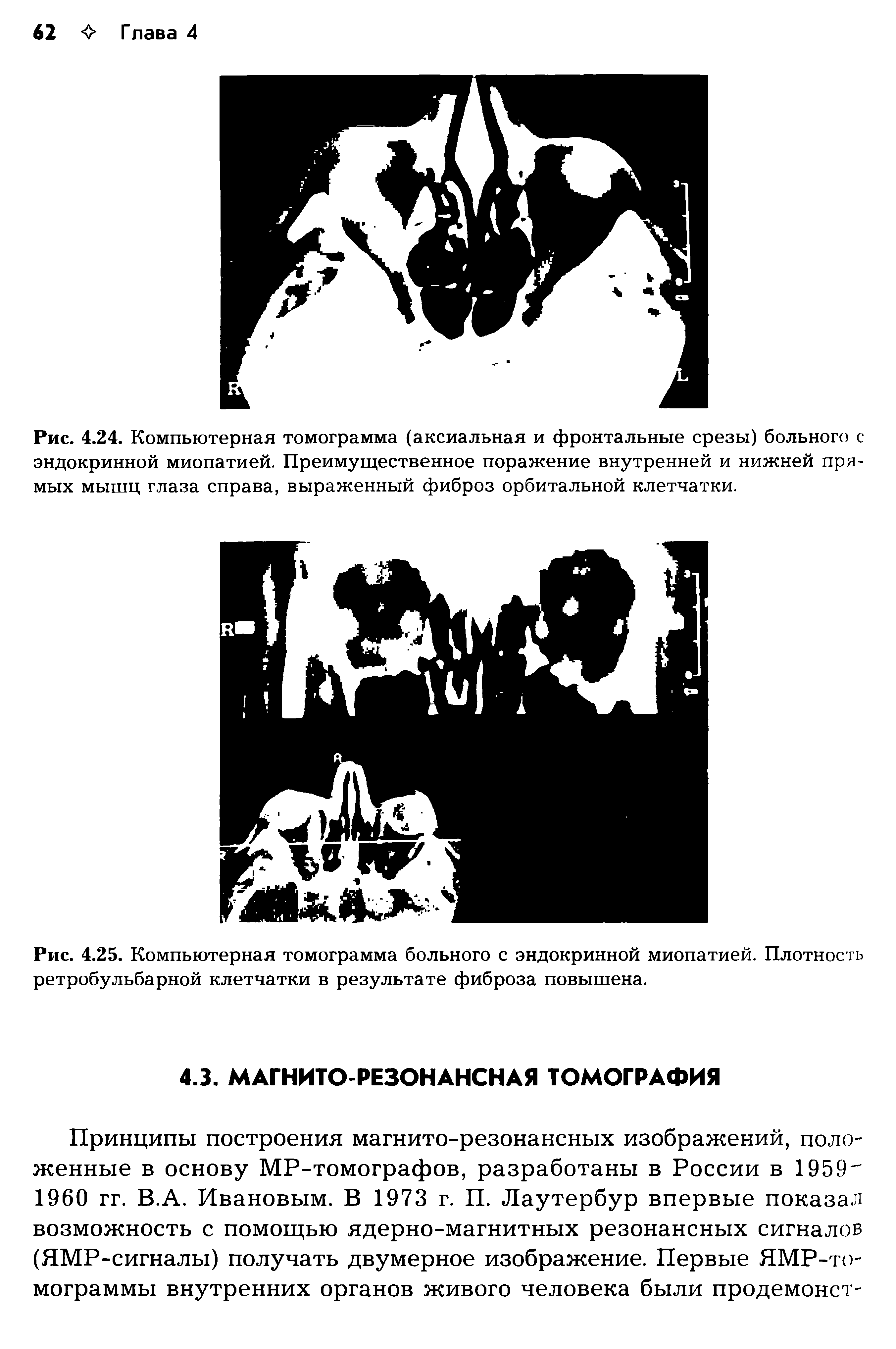 Рис. 4.24. Компьютерная томограмма (аксиальная и фронтальные срезы) больного с эндокринной миопатией. Преимущественное поражение внутренней и нижней прямых мышц глаза справа, выраженный фиброз орбитальной клетчатки.