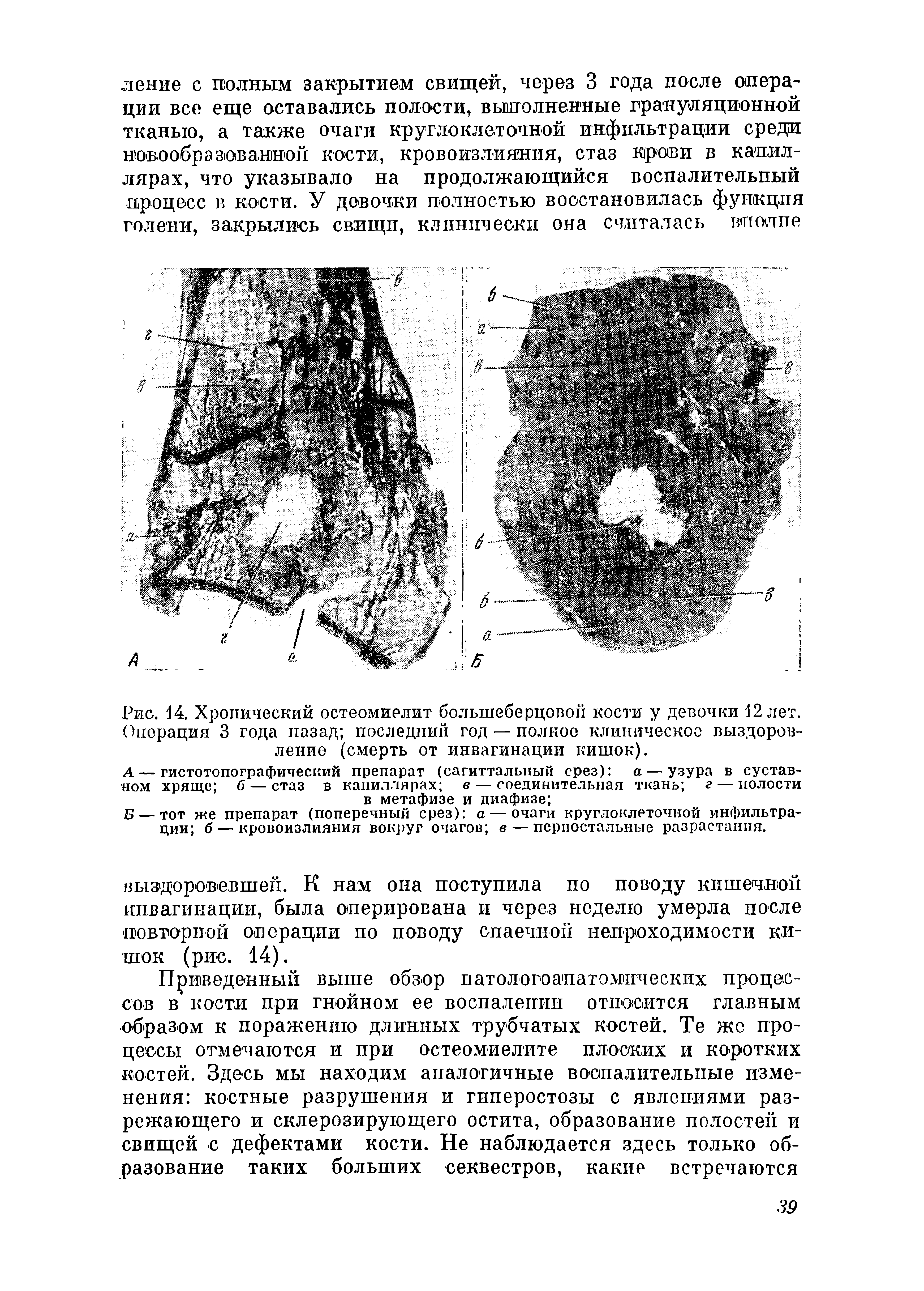 Рис. 14. Хронический остеомиелит большеберцовой кости у девочки 12 лет. Операция 3 года назад последний год — полное клиническое выздоровление (смерть от инвагинации кишок).