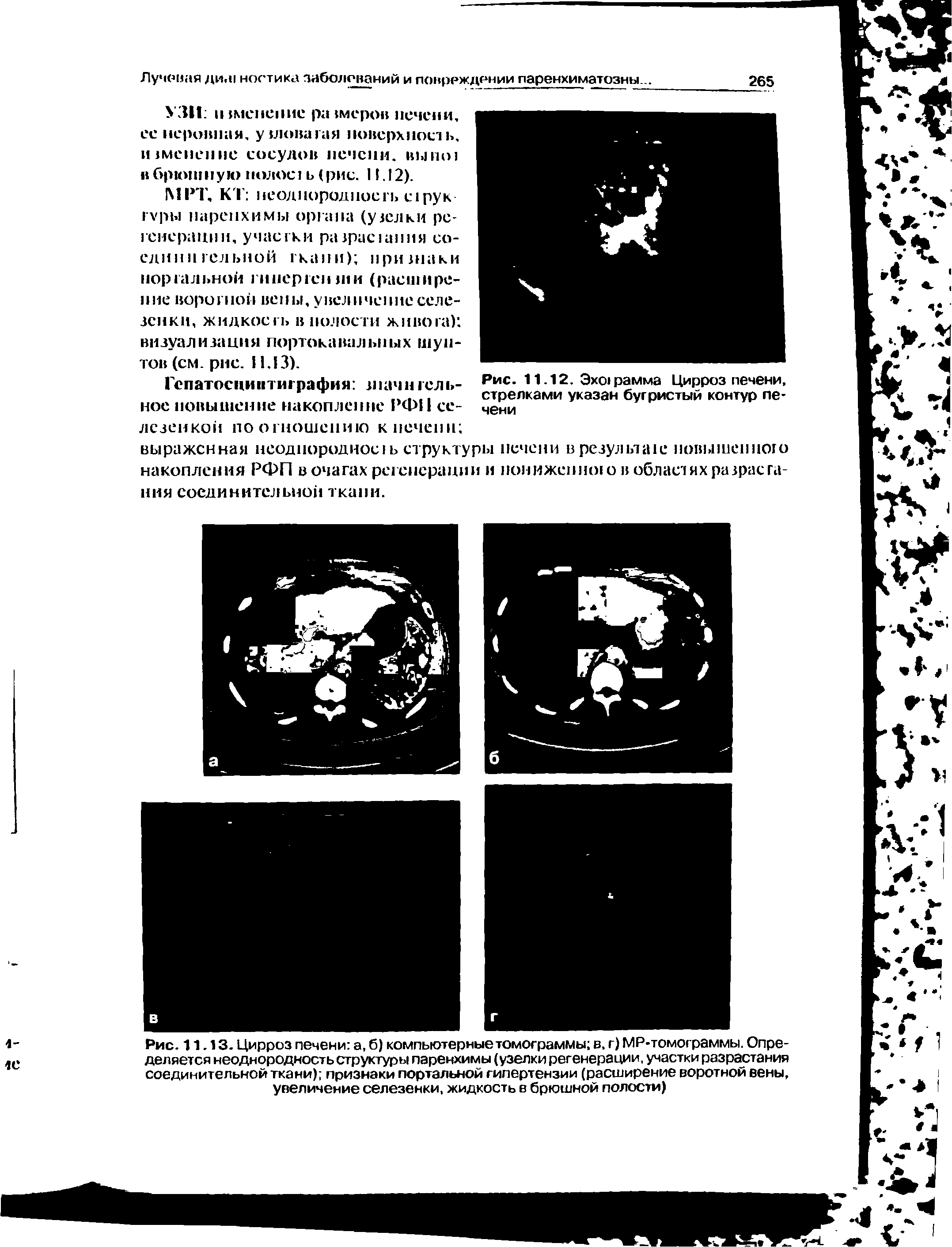 Рис. 11.13. Цирроз печени а, б) компьютерные томограммы в. г) МР-томограммы. Определяется неоднородность структуры паренхимы (узелки регенерации, участки разрастания соединительной ткани) признаки портальной гипертензии (расширение воротной вены, увеличение селезенки, жидкость в брюшной полости)...