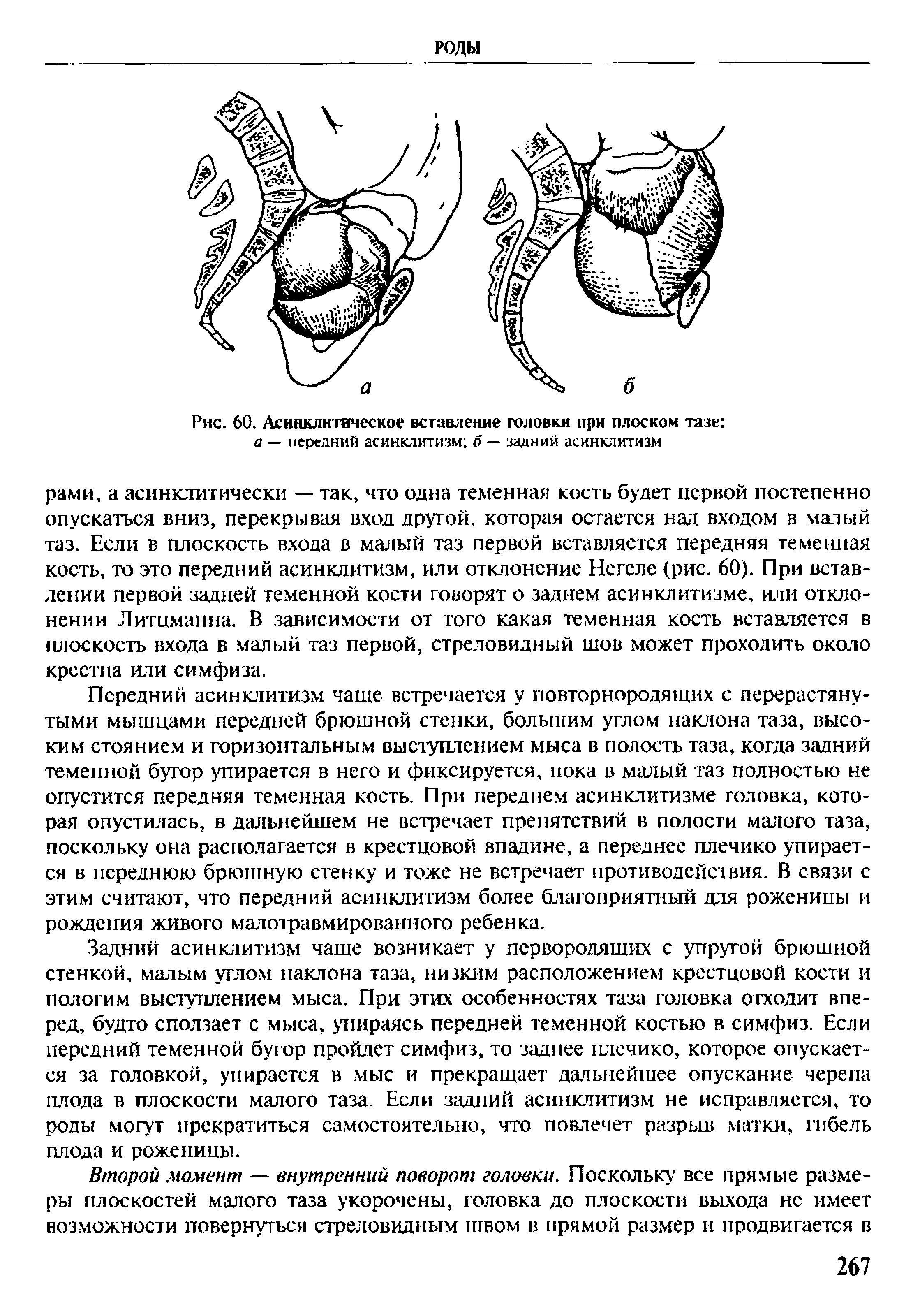 Рис. 60. Асинклитическое вставление головки при плоском тазе а — передний асинклитизм б — задний асинклитизм...