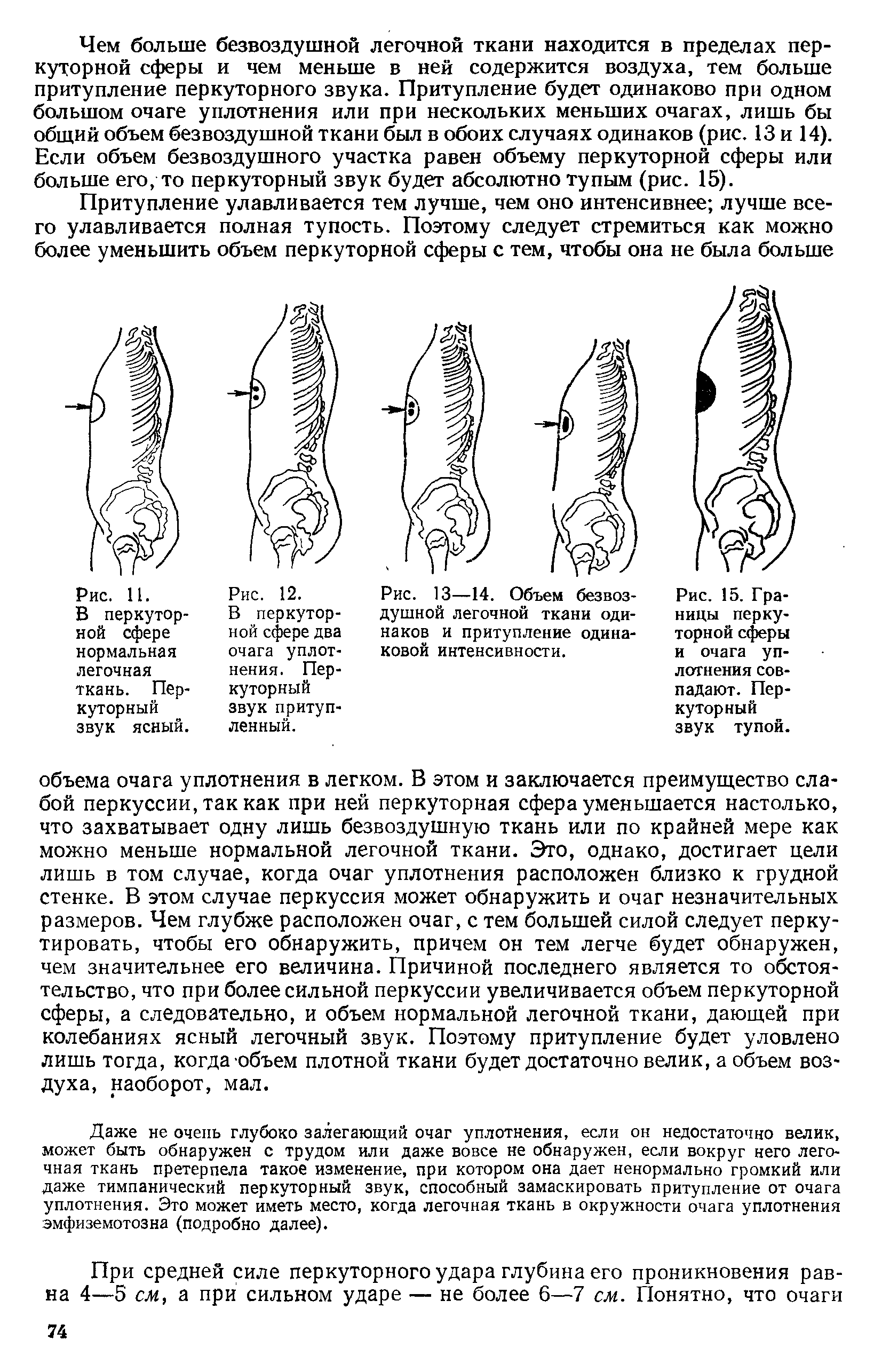 Рис. 15. Границы перкуторной сферы и очага уплотнения совпадают. Перкуторный звук тупой.