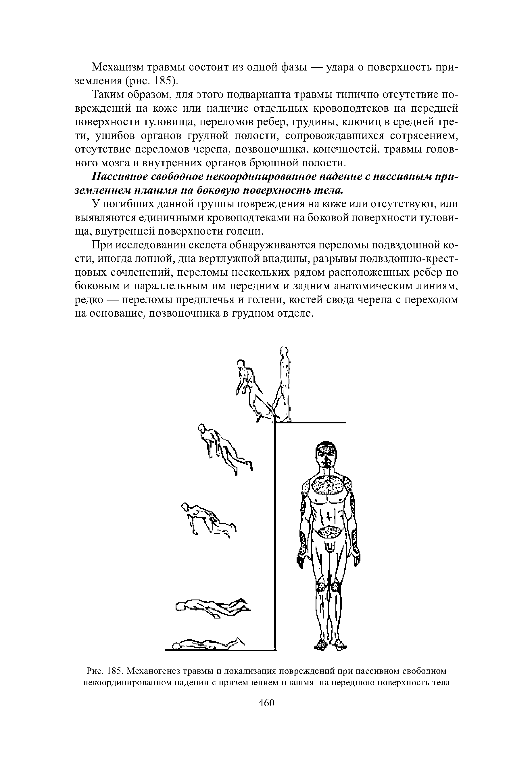 Рис. 185. Механогенез травмы и локализация повреждений при пассивном свободном некоординированном падении с приземлением плашмя на переднюю поверхность тела...