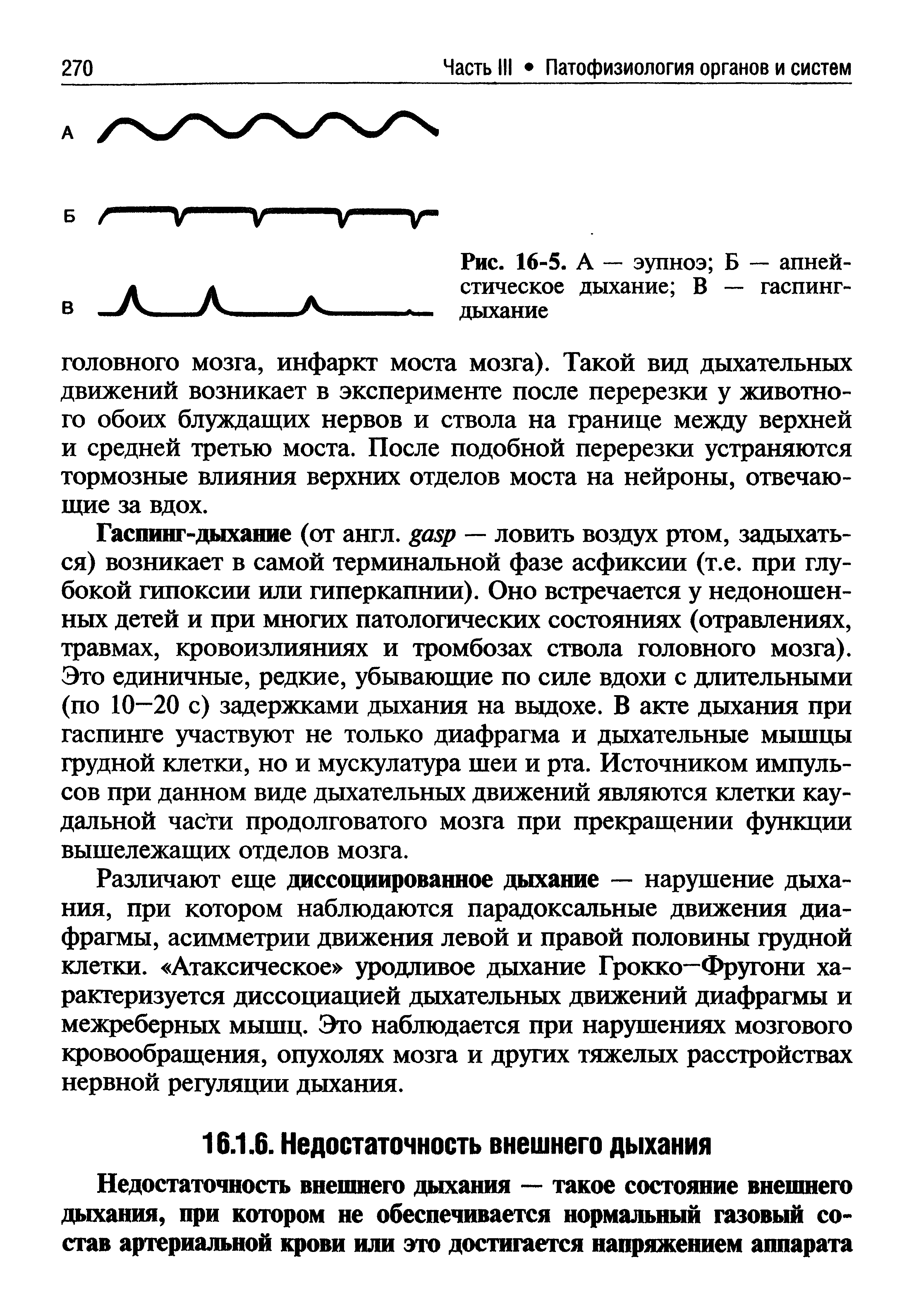 Рис. 16-5. А — эупноэ Б — апней-стическое дыхание В — гаспинг-дыхание...