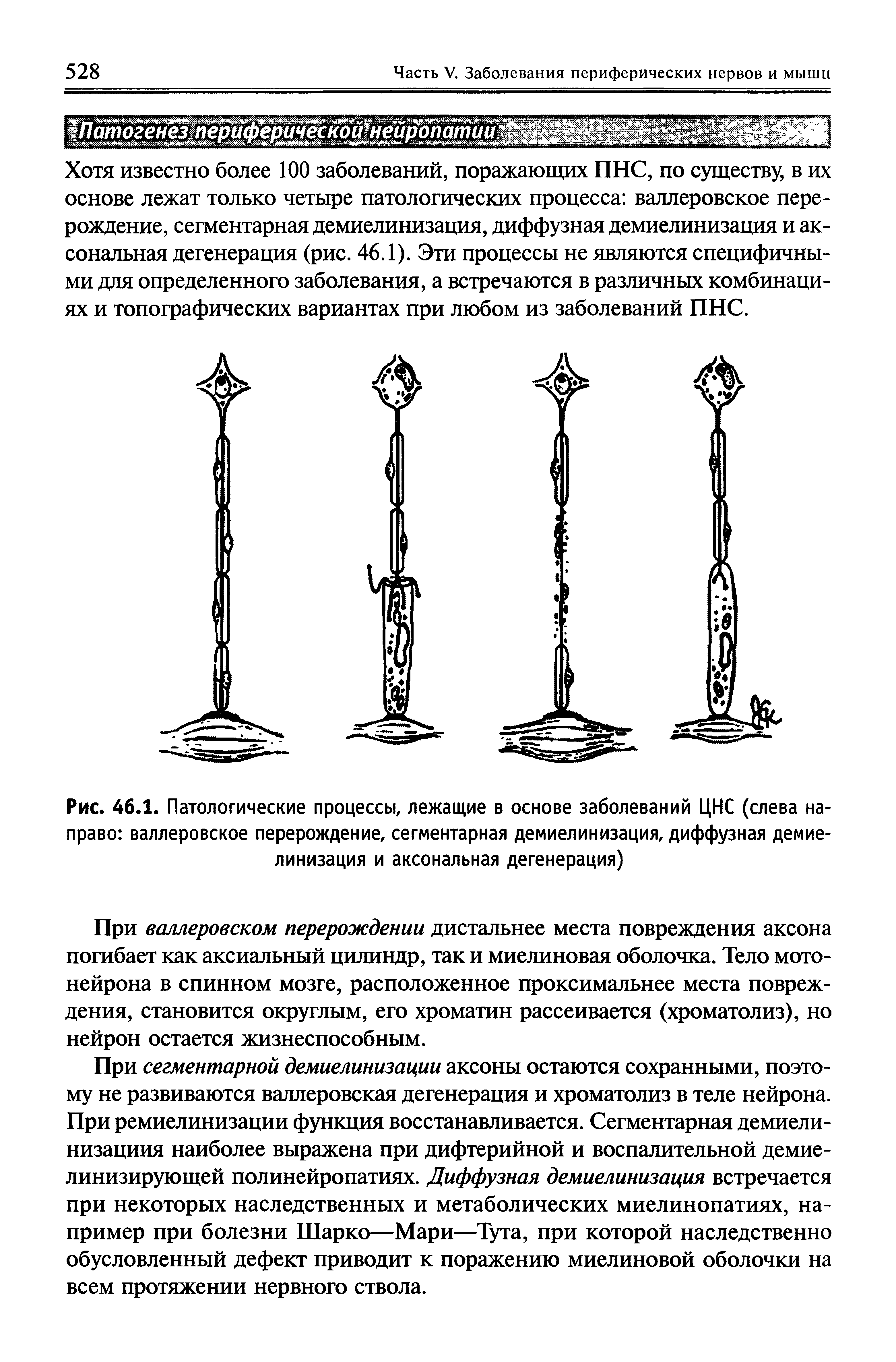 Рис. 46.1. Патологические процессы, лежащие в основе заболеваний ЦНС (слева направо валлеровское перерождение, сегментарная демиелинизация, диффузная демиелинизация и аксональная дегенерация)...