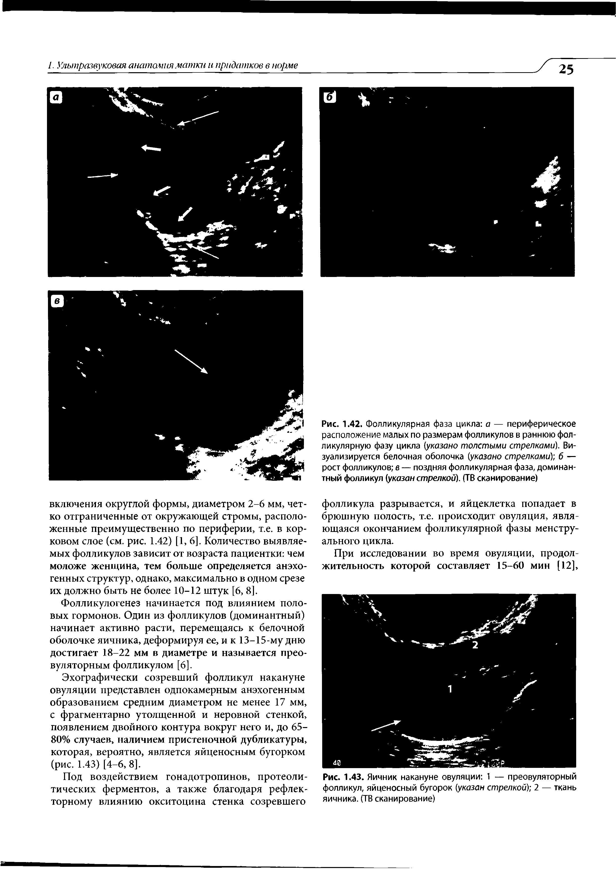 Рис. 1.43. Яичник накануне овуляции 1 — преовуляторный фолликул, яйценосный бугорок (указан стрелкой) 2 — ткань яичника. (ТВ сканирование)...