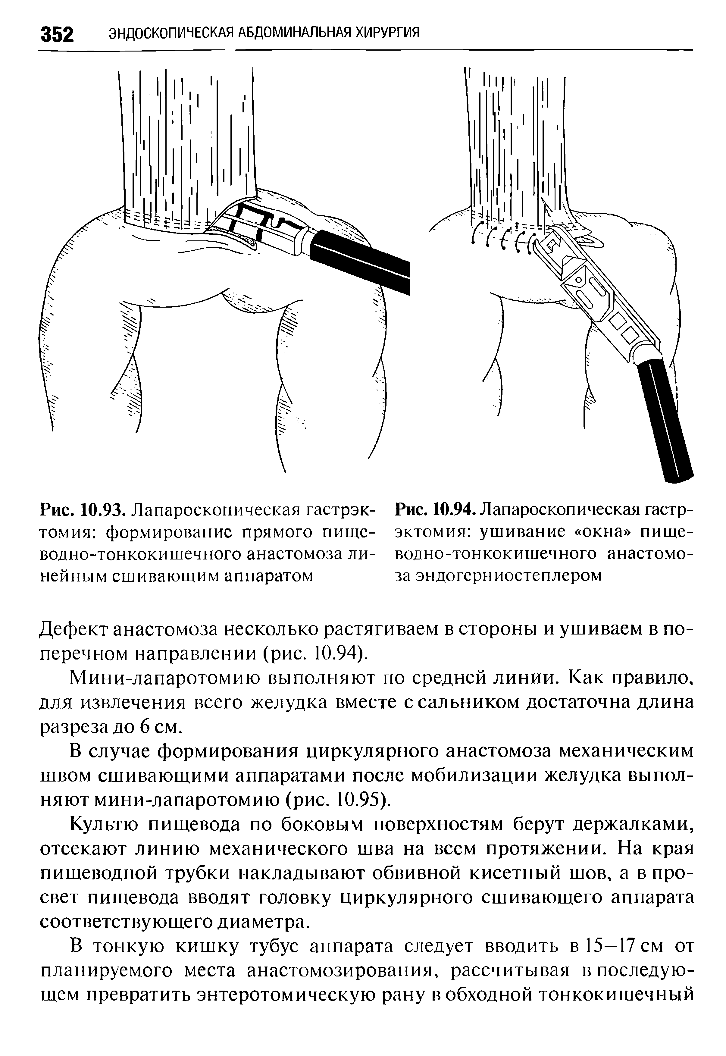 Рис. 10.94. Лапароскопическая гастрэктомия ушивание окна пищеводно-тонкокишечного анастомоза эндогерниостеплером...