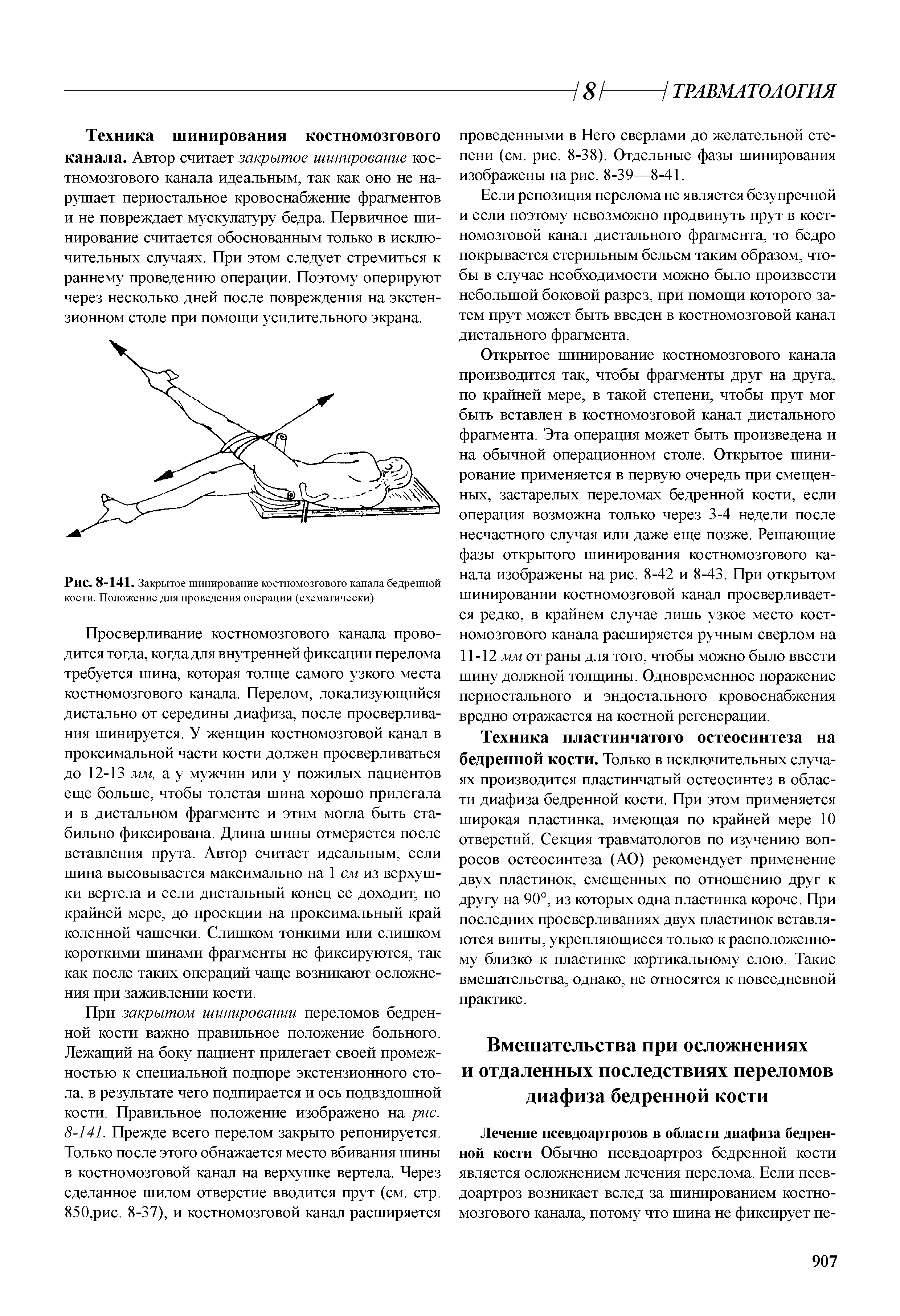 Рис. 8-141. Закрытое шинирование костномозгового канала бедренной кости. Положение для проведения операции (схематически)...