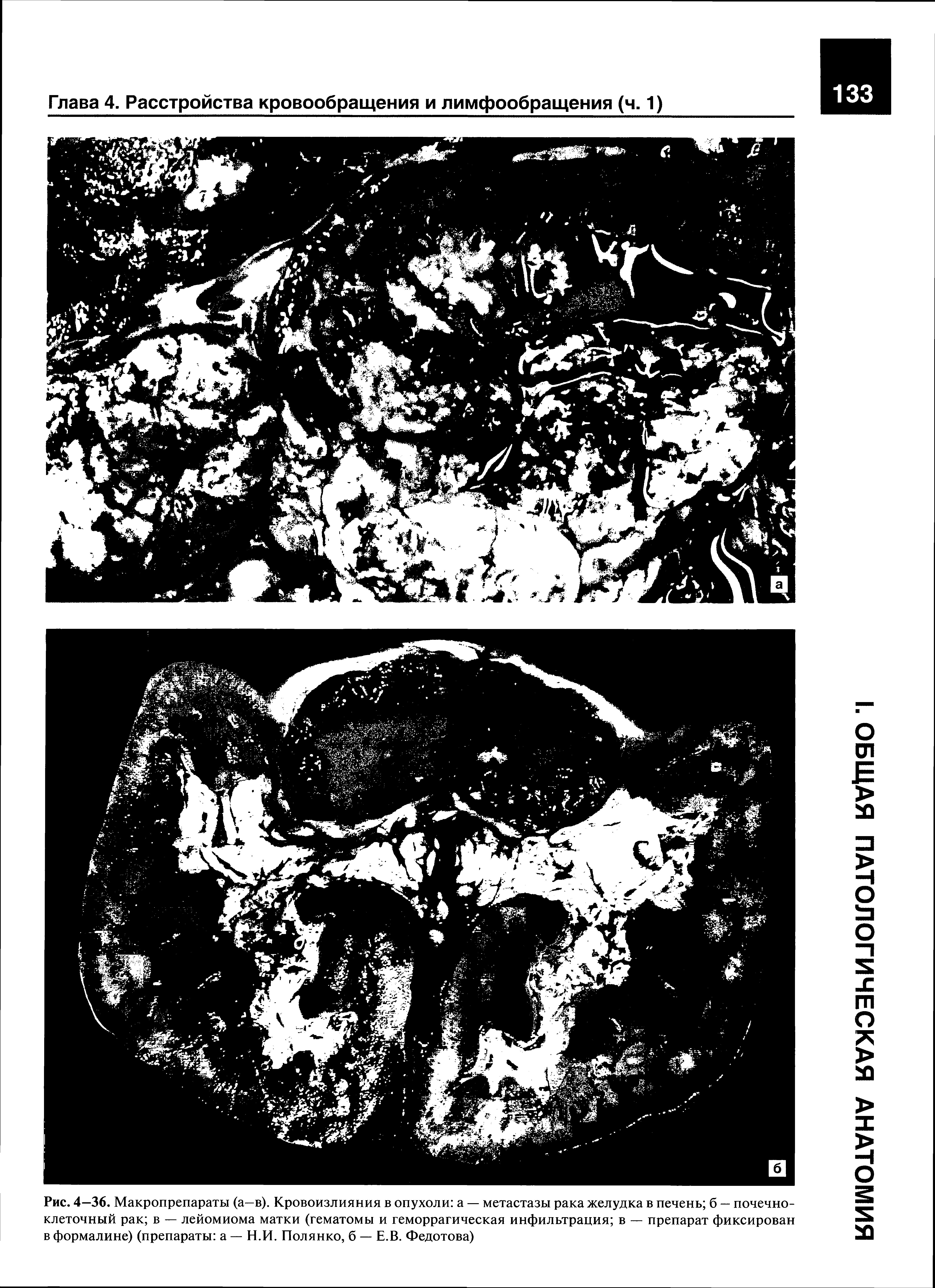 Рис. 4—36. Макропрепараты (а—в). Кровоизлияния в опухоли а — метастазы рака желудка в печень б — почечноклеточный рак в — лейомиома матки (гематомы и геморрагическая инфильтрация в — препарат фиксирован в формалине) (препараты а — Н.И. Полянко, б — Е.В. Федотова)...