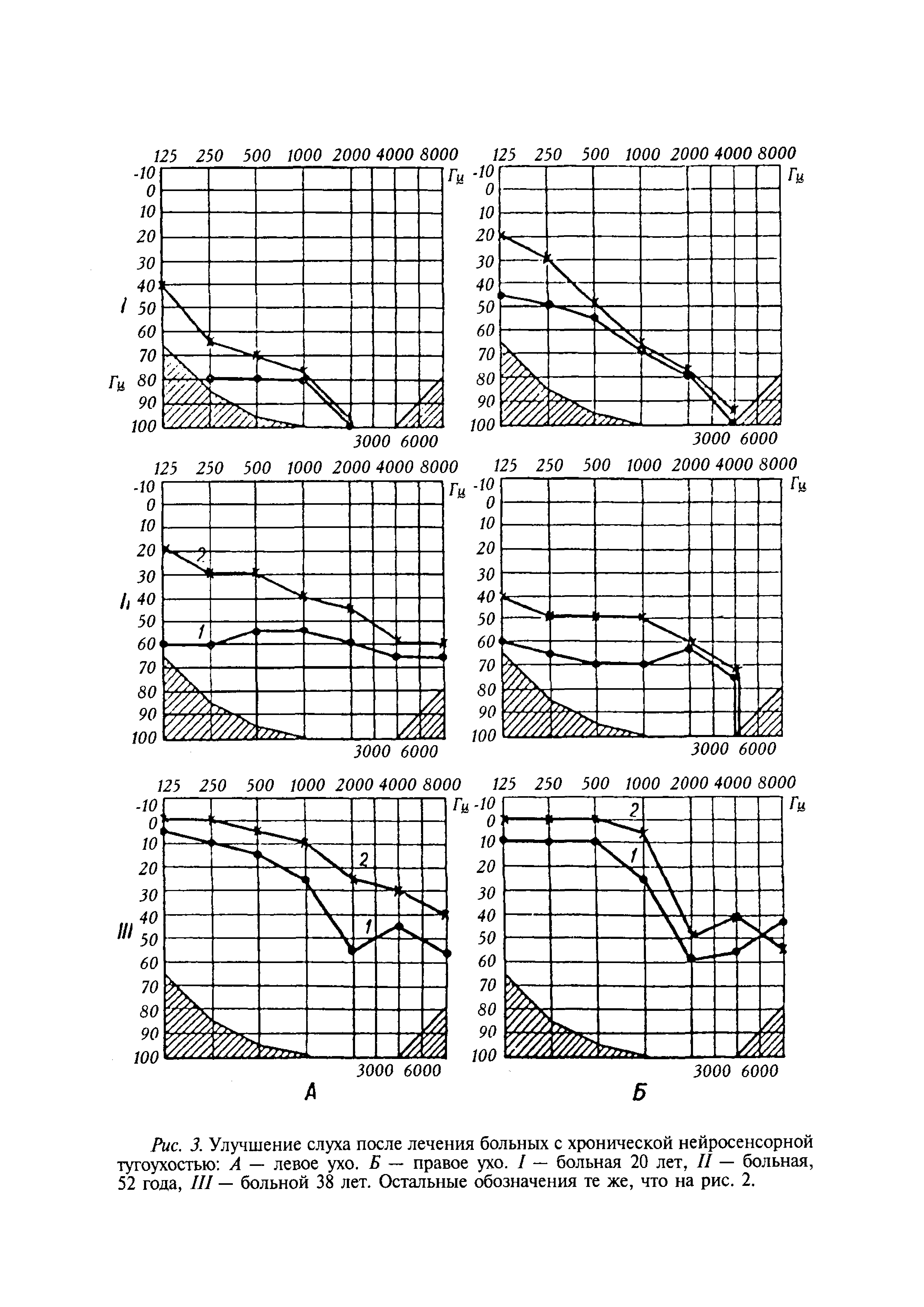 Рис. 3. Улучшение слуха после лечения больных с хронической нейросенсорной тугоухостью А — левое ухо. Б — правое ухо. I — больная 20 лет, II — больная, 52 года, III — больной 38 лет. Остальные обозначения те же, что на рис. 2.