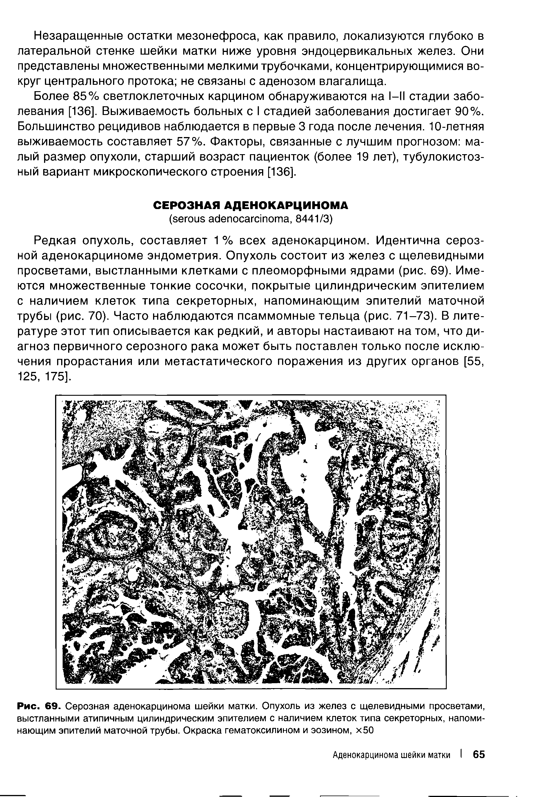 Рис. 69. Серозная аденокарцинома шейки матки. Опухоль из желез с щелевидными просветами, выстланными атипичным цилиндрическим эпителием с наличием клеток типа секреторных, напоминающим эпителий маточной трубы. Окраска гематоксилином и эозином, х50...