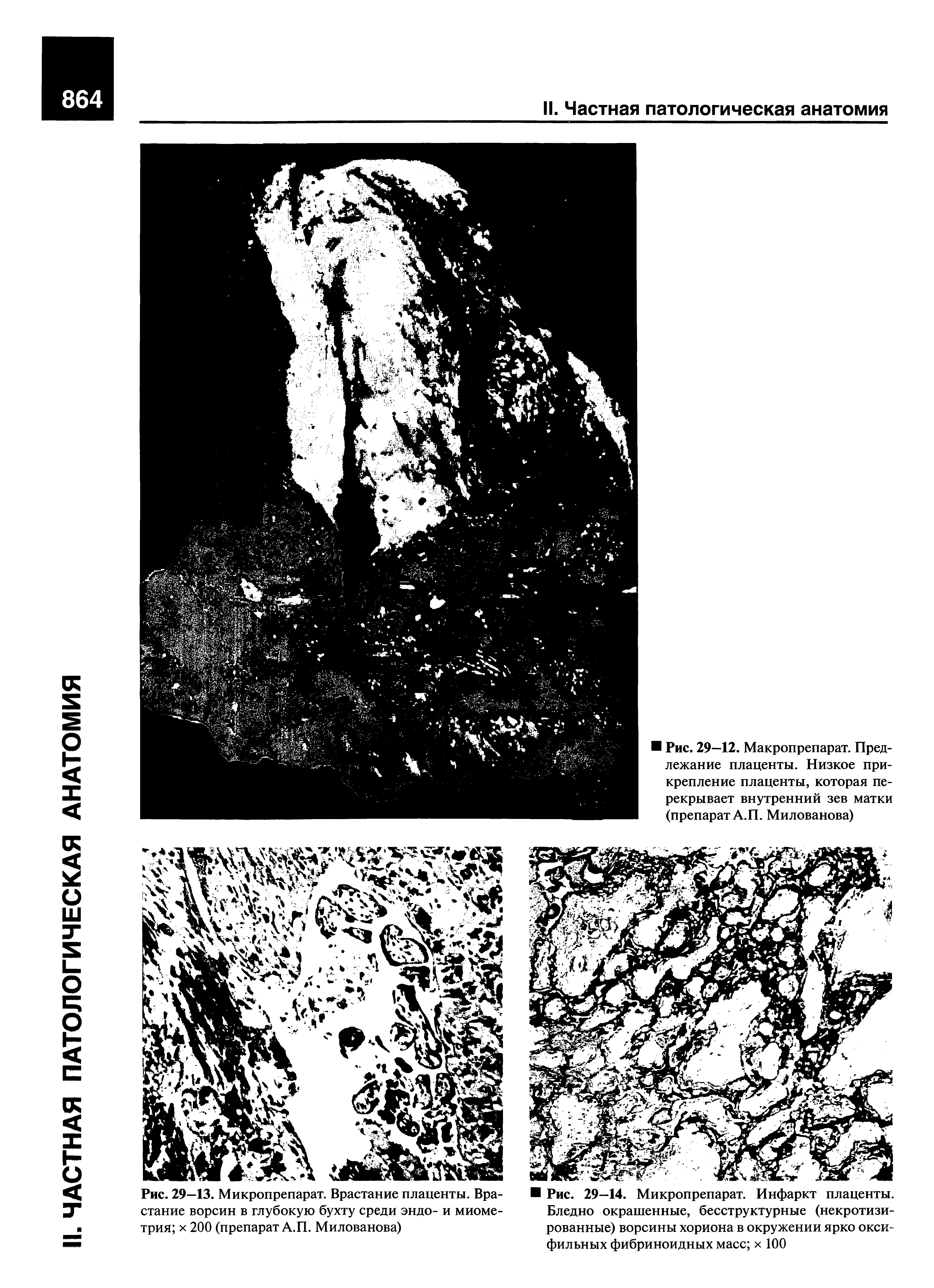 Рис. 29—13. Микропрепарат. Врастание плаценты. Врастание ворсин в глубокую бухту среди эндо- и миометрия х 200 (препарат А.П. Милованова)...