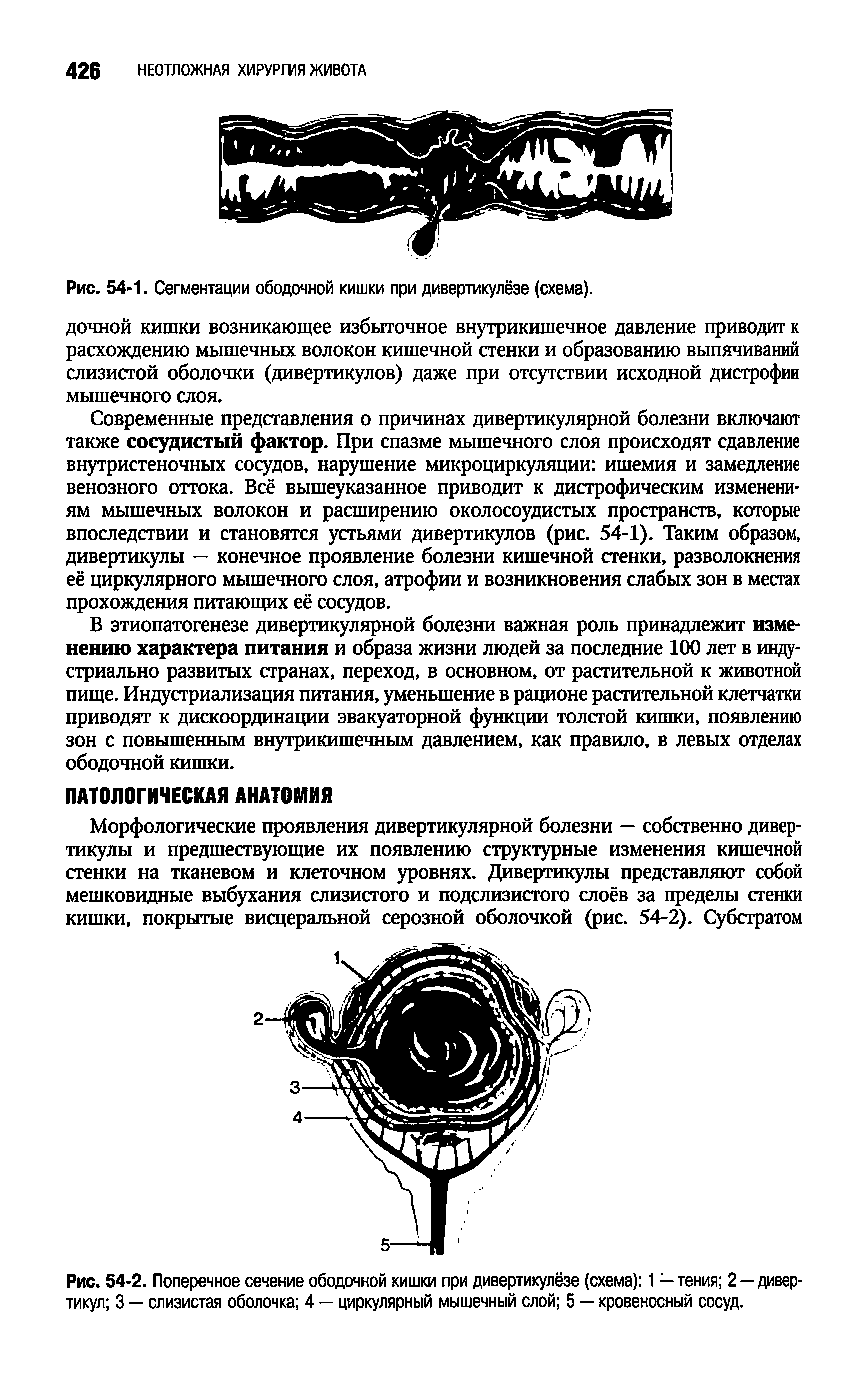 Рис. 54-2. Поперечное сечение ободочной кишки при дивертикулёзе (схема) 1 — тения 2 —дивер тикул 3 — слизистая оболочка 4 — циркулярный мышечный слой 5 — кровеносный сосуд.