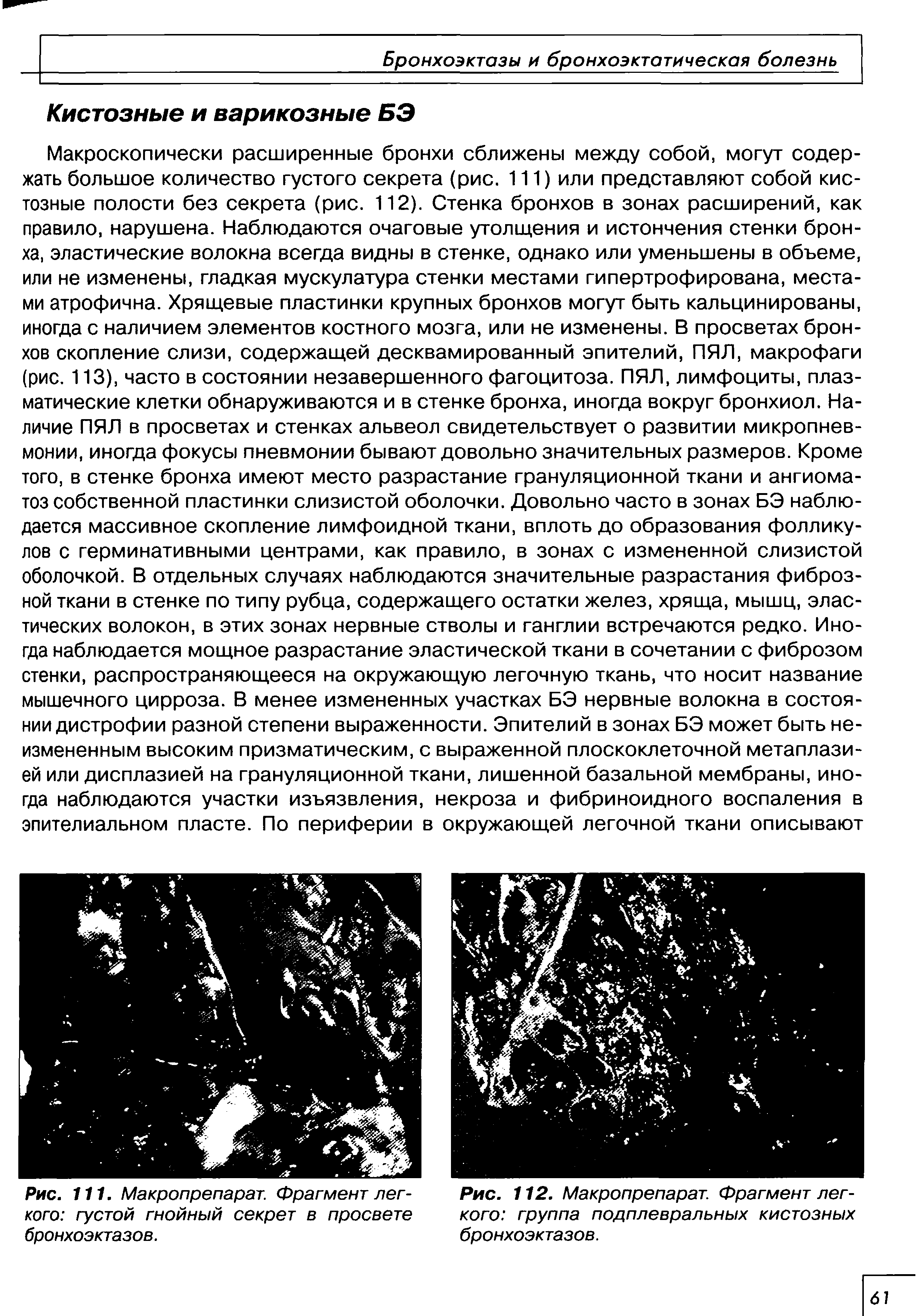 Рис. 111. Макропрепарат. Фрагмент легкого густой гнойный секрет в просвете бронхоэктазов.