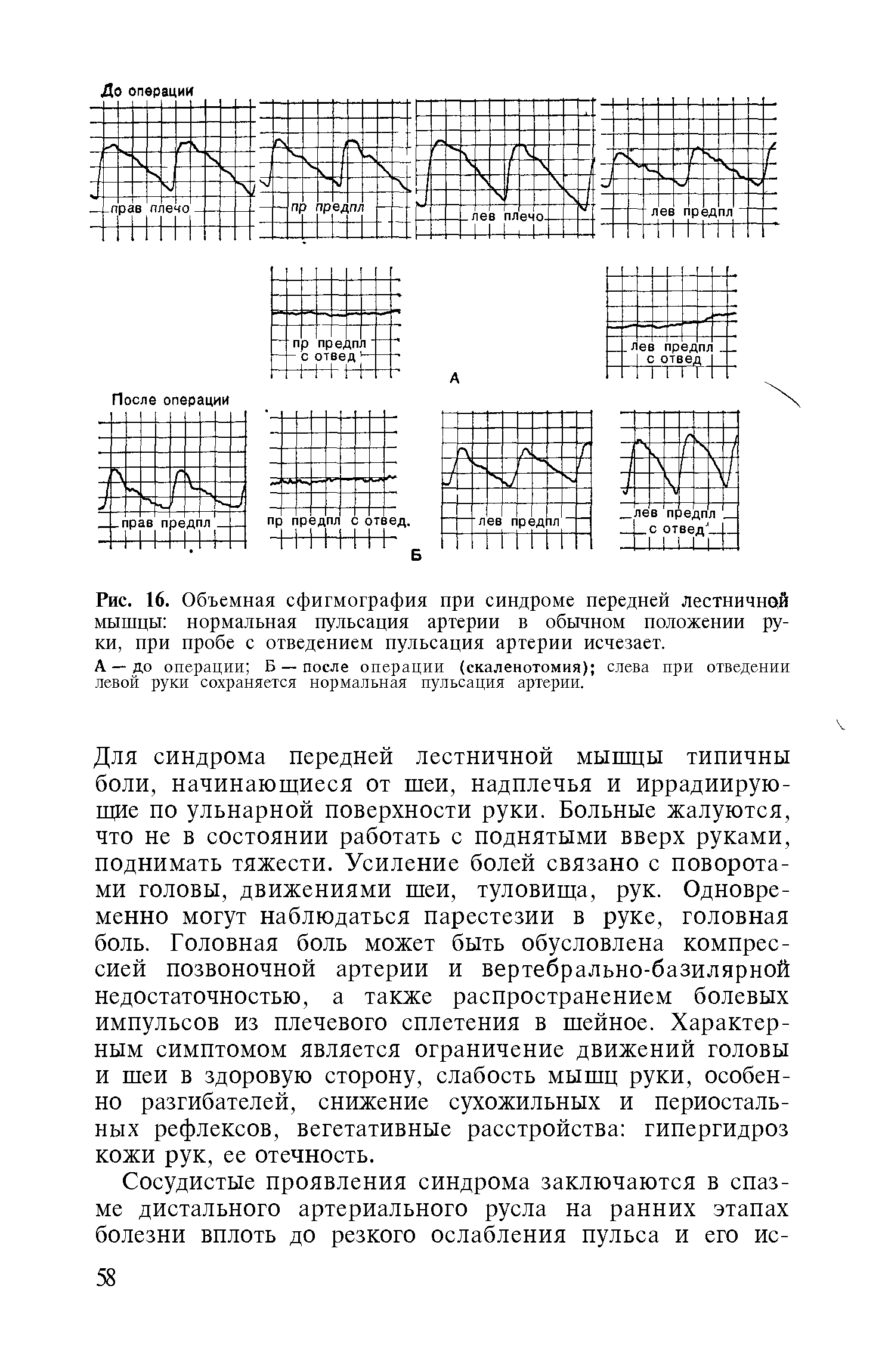 Рис. 16. Объемная сфигмография при синдроме передней лестничной мышцы нормальная пульсация артерии в обычном положении руки, при пробе с отведением пульсация артерии исчезает.