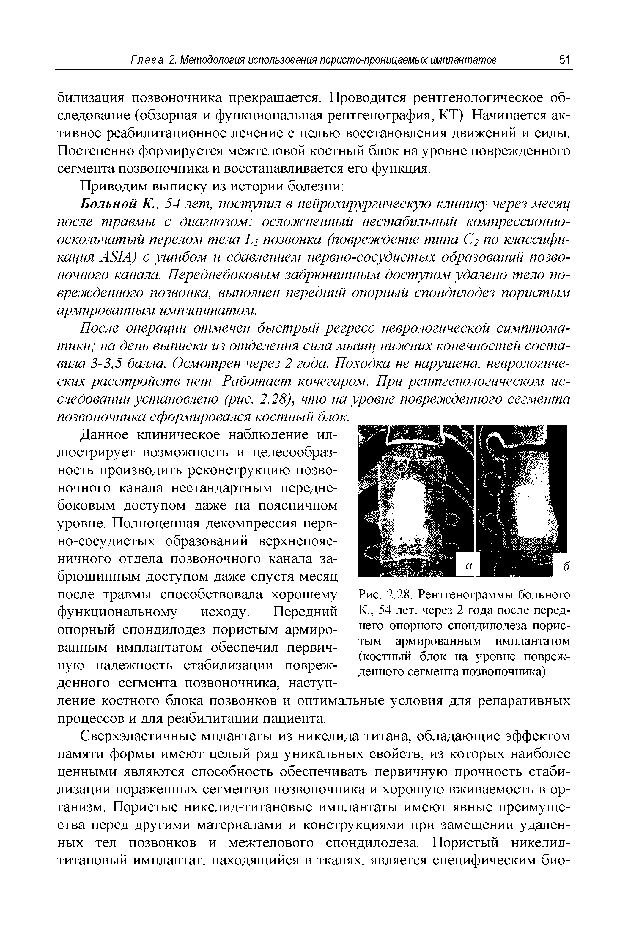 Рис. 2.28. Рентгенограммы больного К., 54 лет, через 2 года после переднего опорного спондилодеза пористым армированным имплантатом (костный блок на уровне поврежденного сегмента позвоночника)...