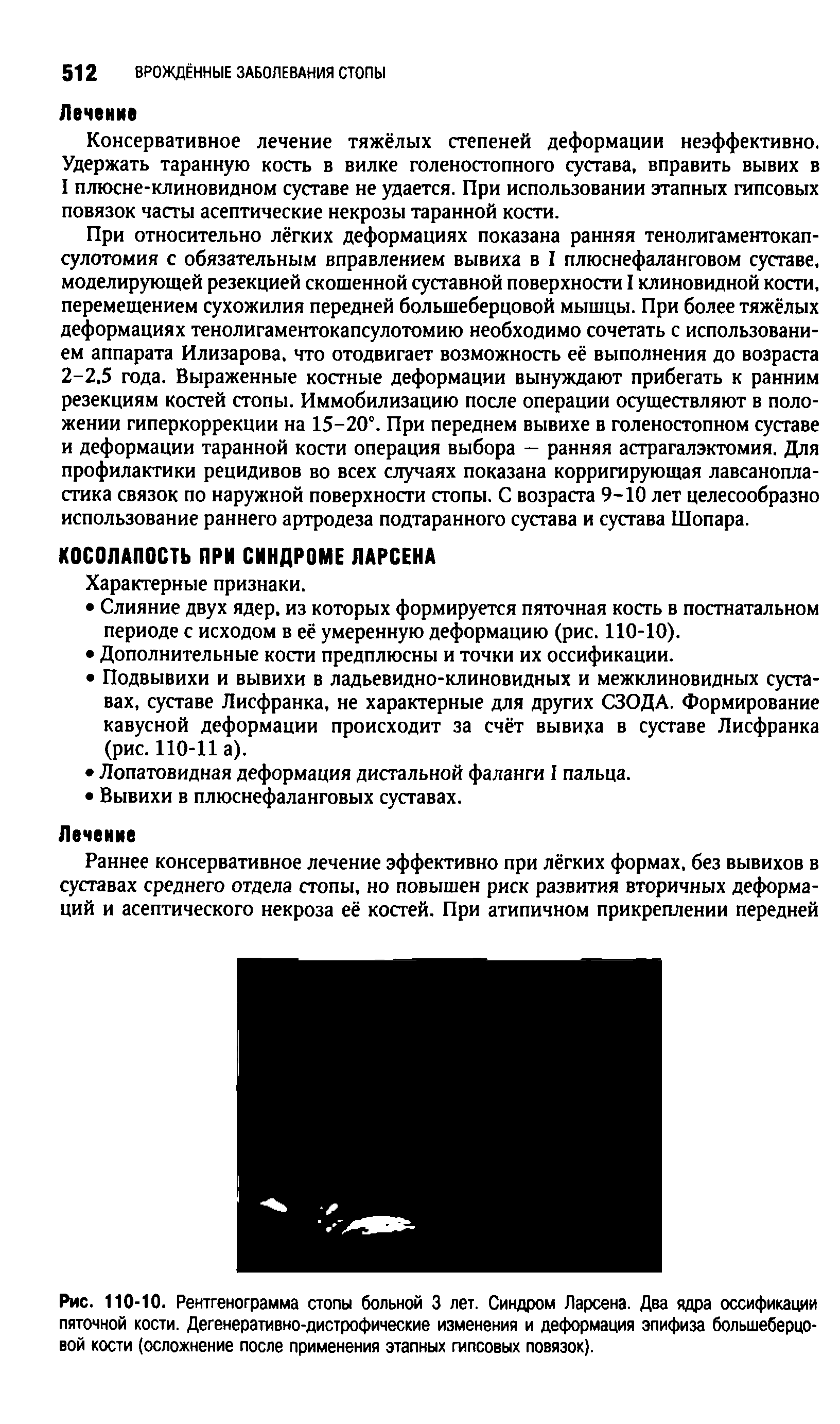 Рис. 110-10. Рентгенограмма стопы больной 3 лет. Синдром Ларсена. Два ядра оссификации пяточной кости. Дегенеративно-дистрофические изменения и деформация эпифиза большеберцовой кости (осложнение после применения этапных гипсовых повязок).