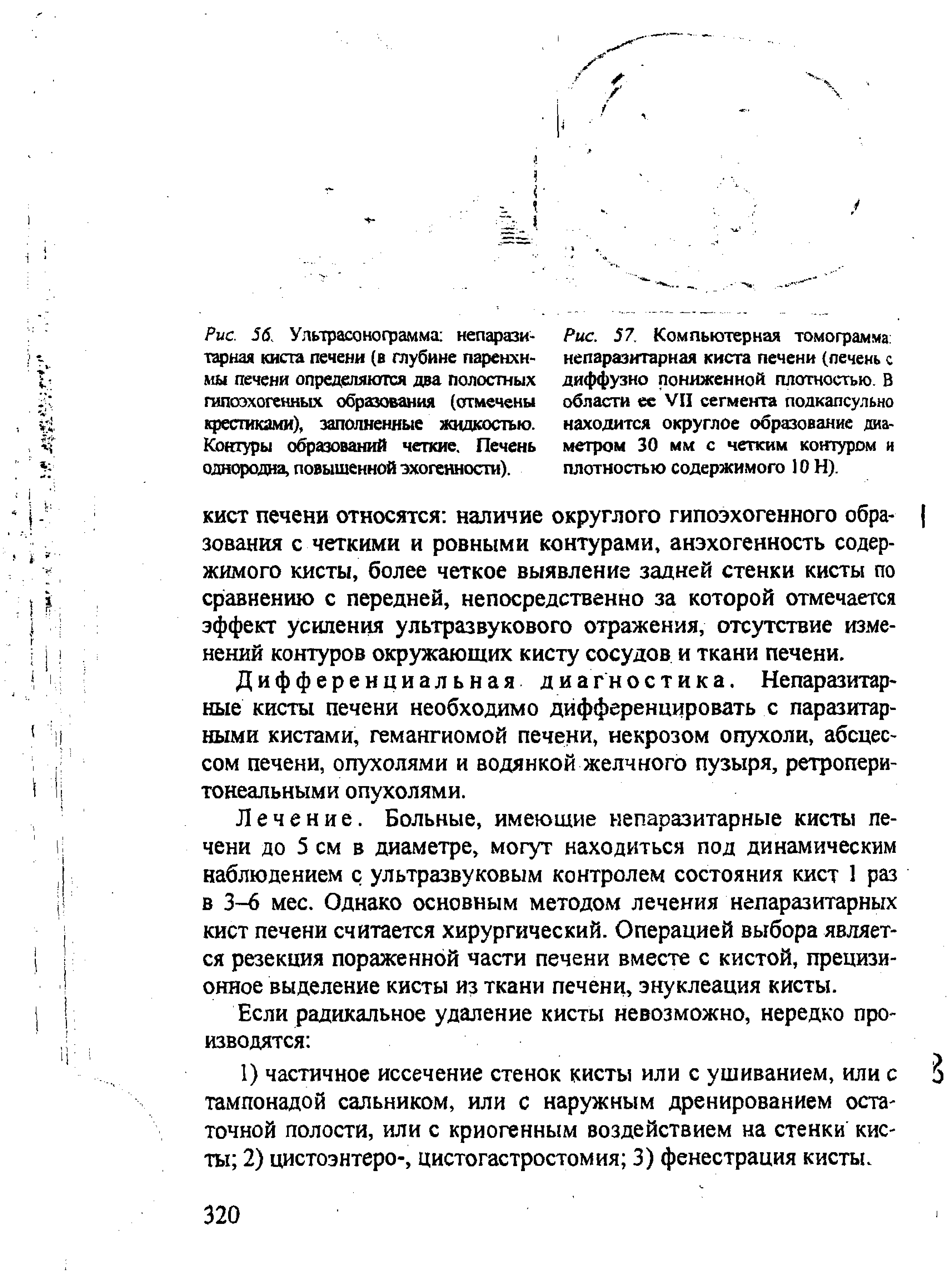 Рис. 57. Компьютерная томограмма непаразитарная киста печени (печень с диффузно пониженной плотностью. В области ее VII сегмента подкапсульно находится округлое образование диаметром 30 мм с четким контуром и плотностью содержимого 10 Н).