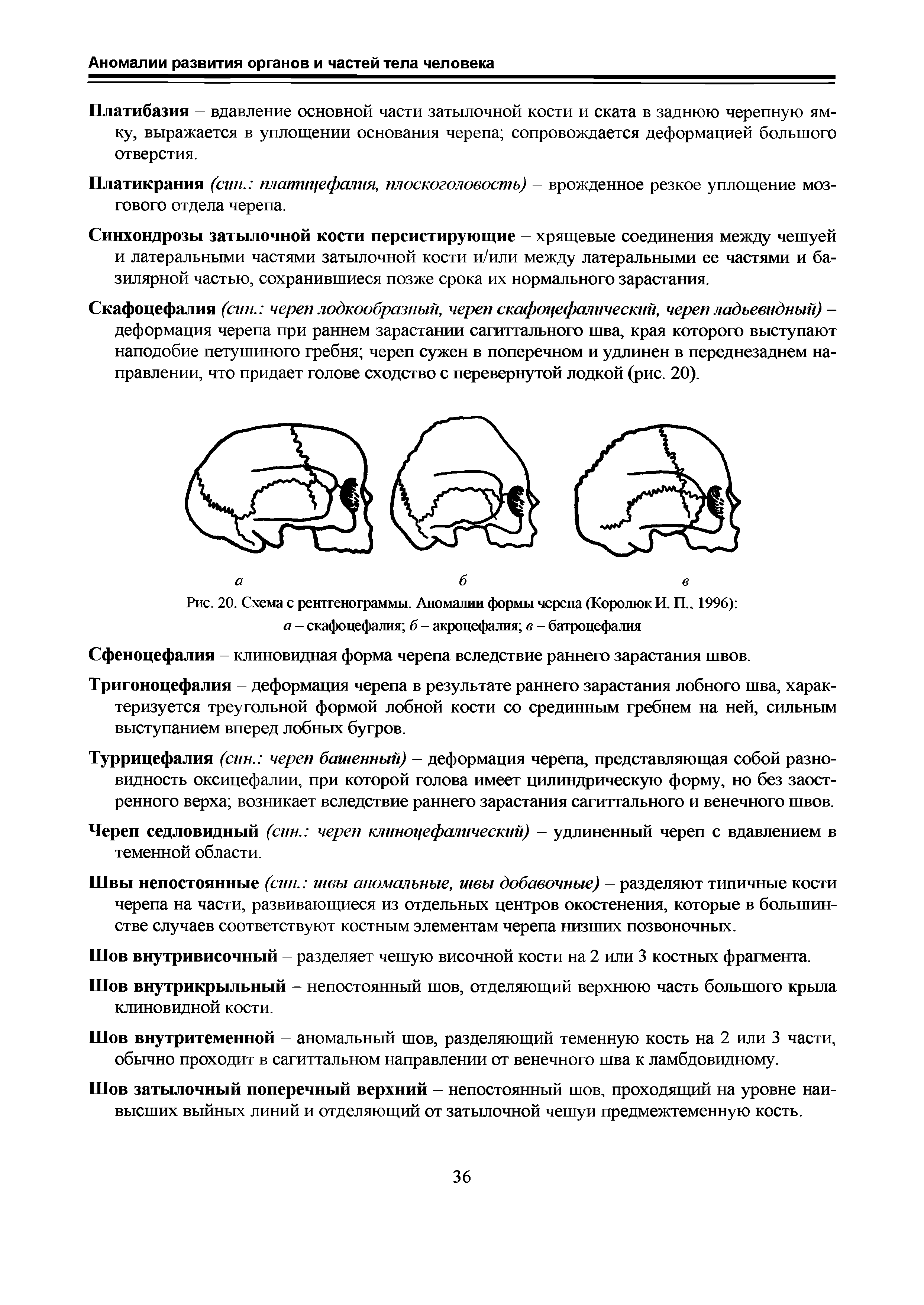 Рис. 20. Схема с рентгенограммы. Аномалии формы черепа (Королюк И. П 1996) а - скафоцефалия б - акроцефалия в - батроцефалия...