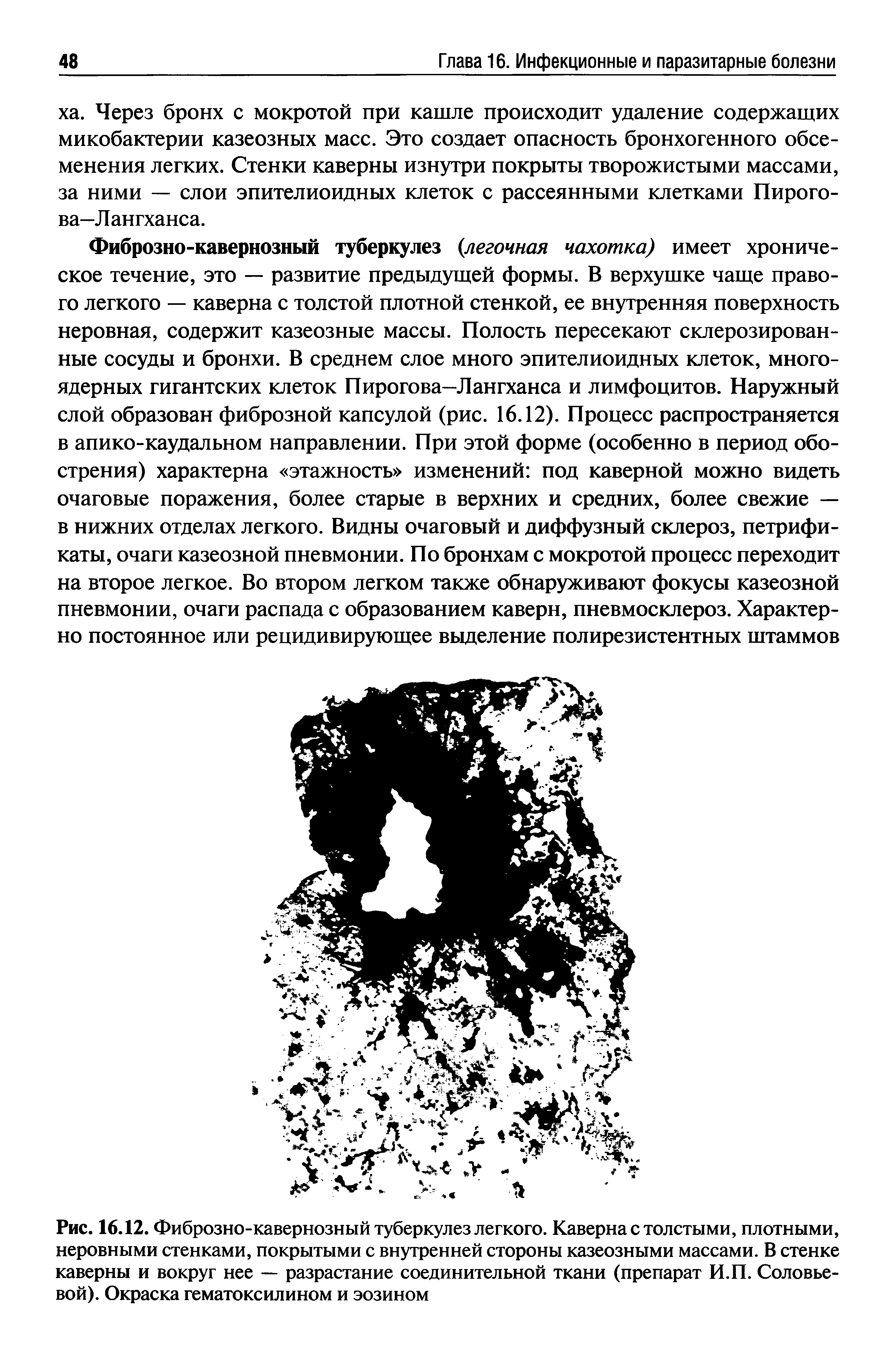 Рис. 16.12. Фиброзно-кавернозный туберкулез легкого. Каверна с толстыми, плотными, неровными стенками, покрытыми с внутренней стороны казеозными массами. В стенке каверны и вокруг нее — разрастание соединительной ткани (препарат И.П. Соловьевой). Окраска гематоксилином и эозином...