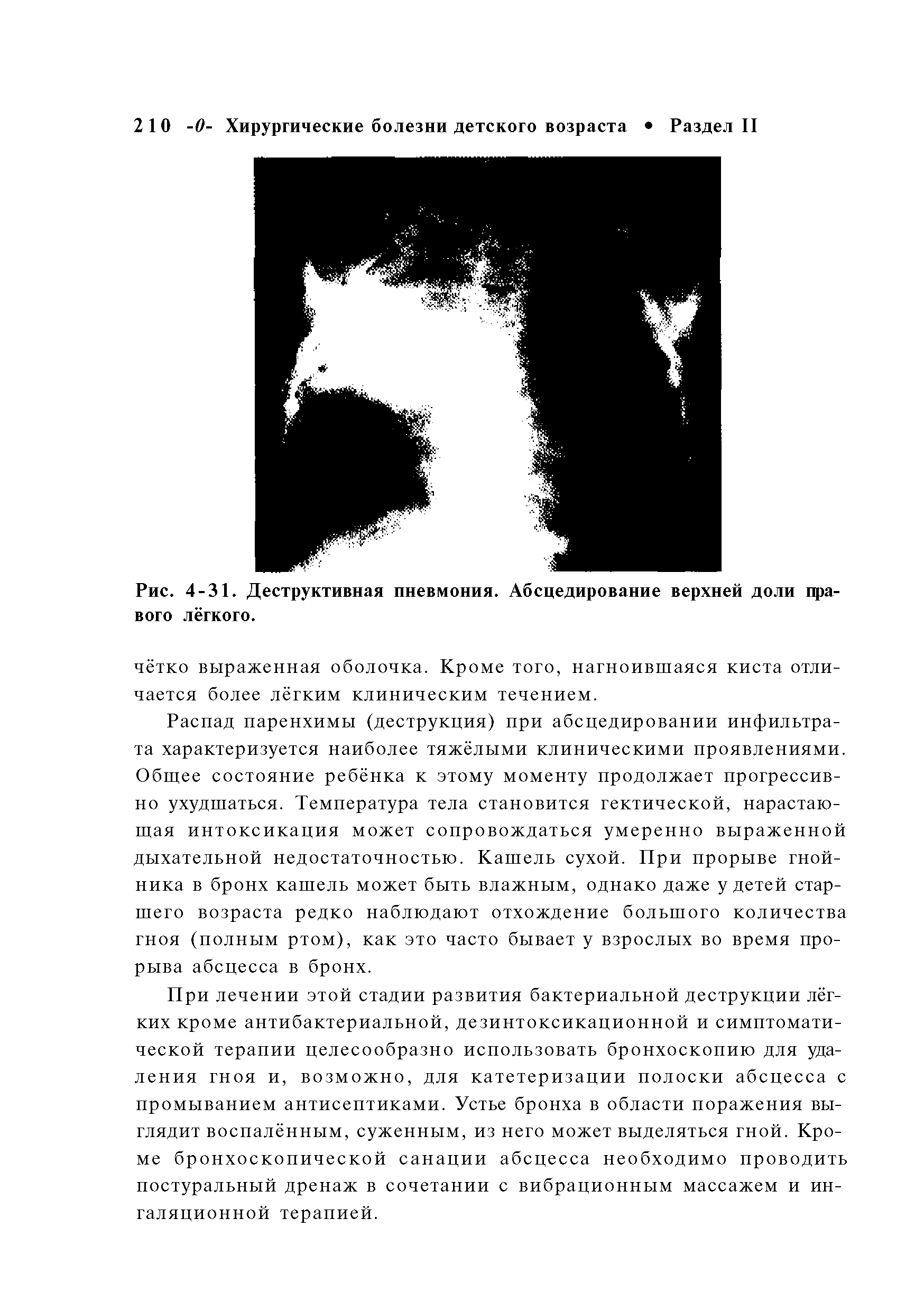 Рис. 4-31. Деструктивная пневмония. Абсцедирование верхней доли правого лёгкого.