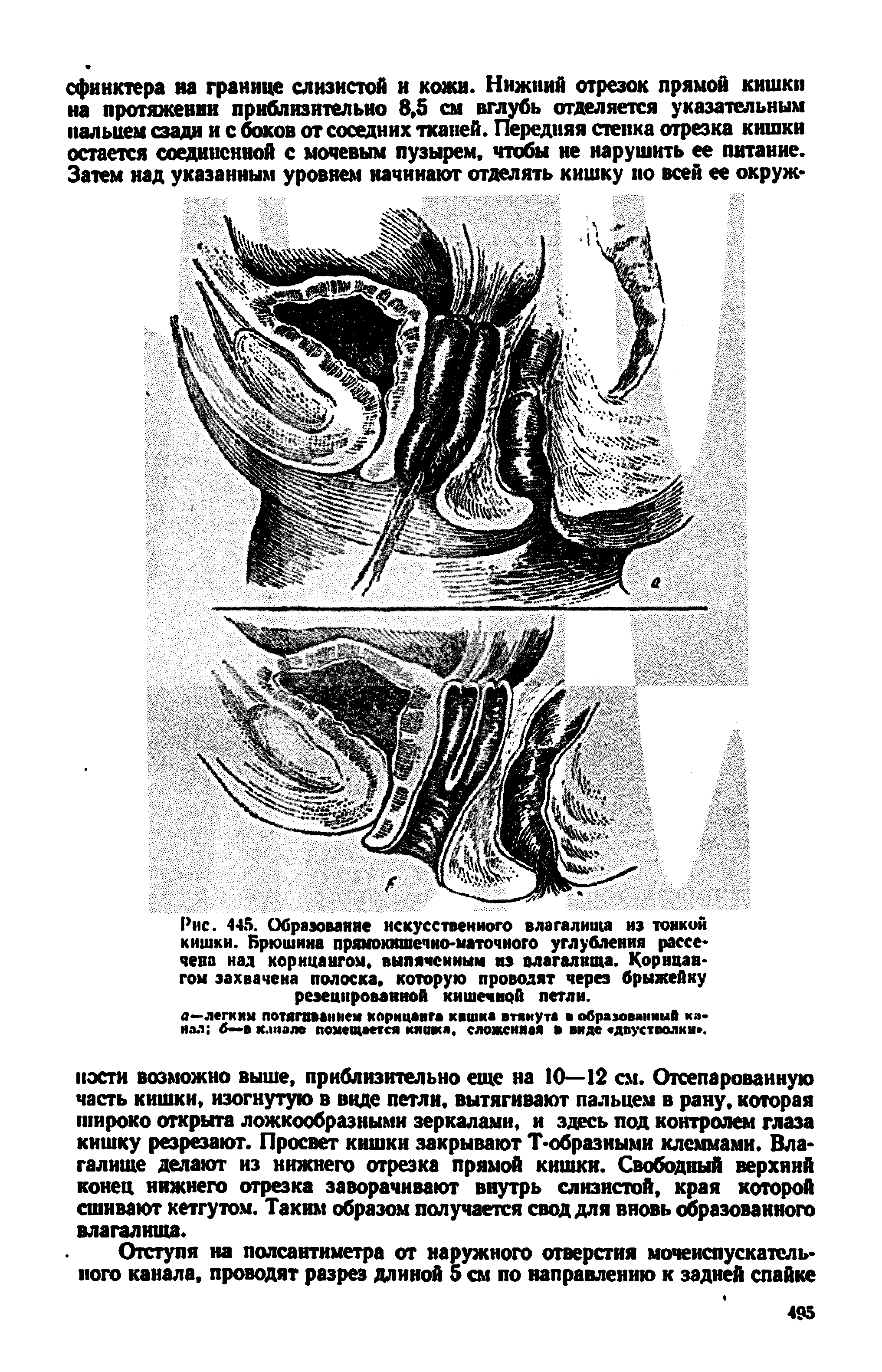 Рис. 445. Образование искусственного влагалища из тонкий кишки. Брюшина прямокишечно-маточного углубления рассечена над корнцангом, выпяченным из влагалища. Корнцангом захвачена полоска, которую проводят через брыжейку резецированной кишечной петли.