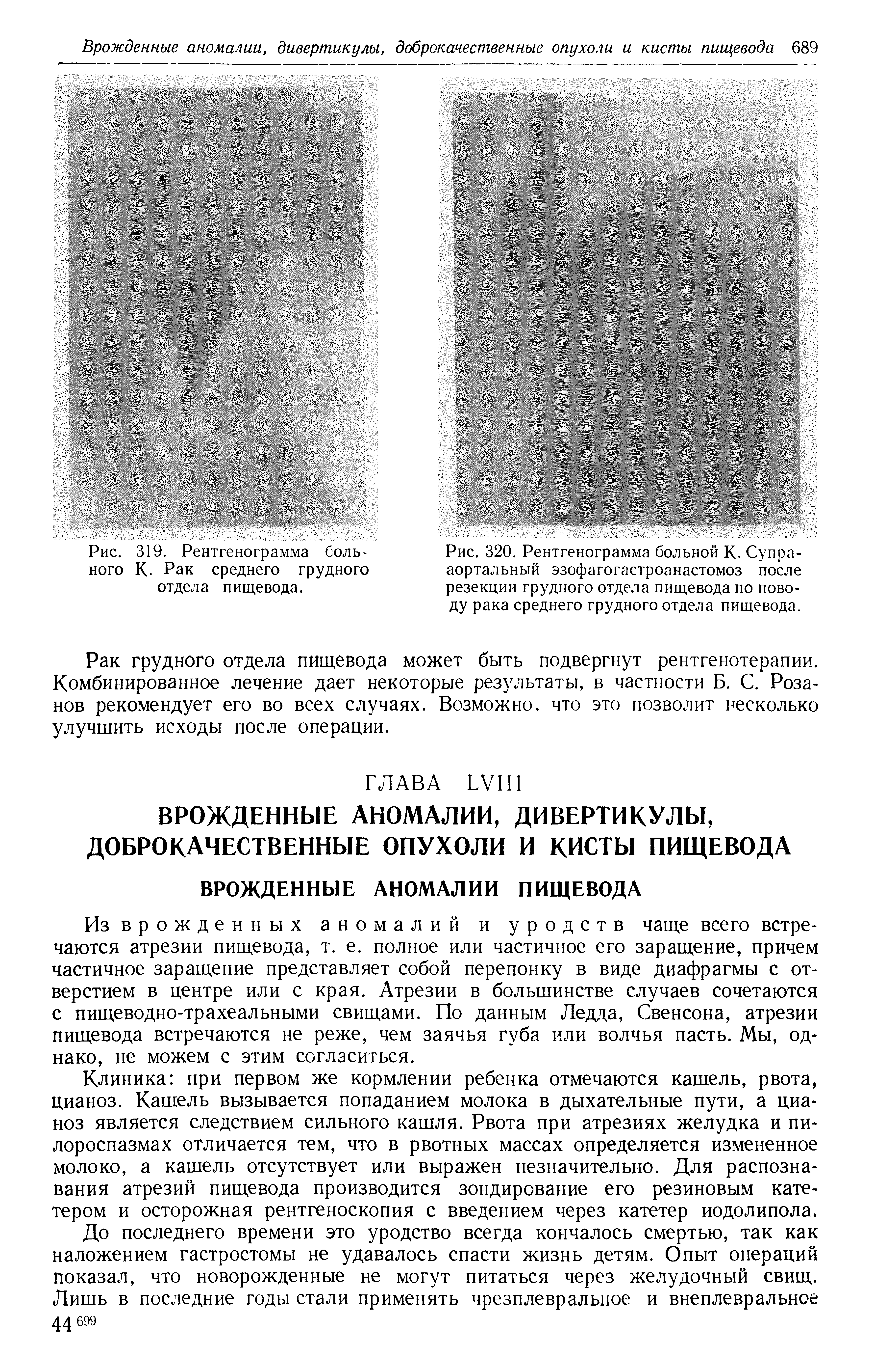 Рис. 320. Рентгенограмма больной К. Супра-аортальный эзофагогастроанастомоз после резекции грудного отдела пищевода по поводу рака среднего грудного отдела пищевода.