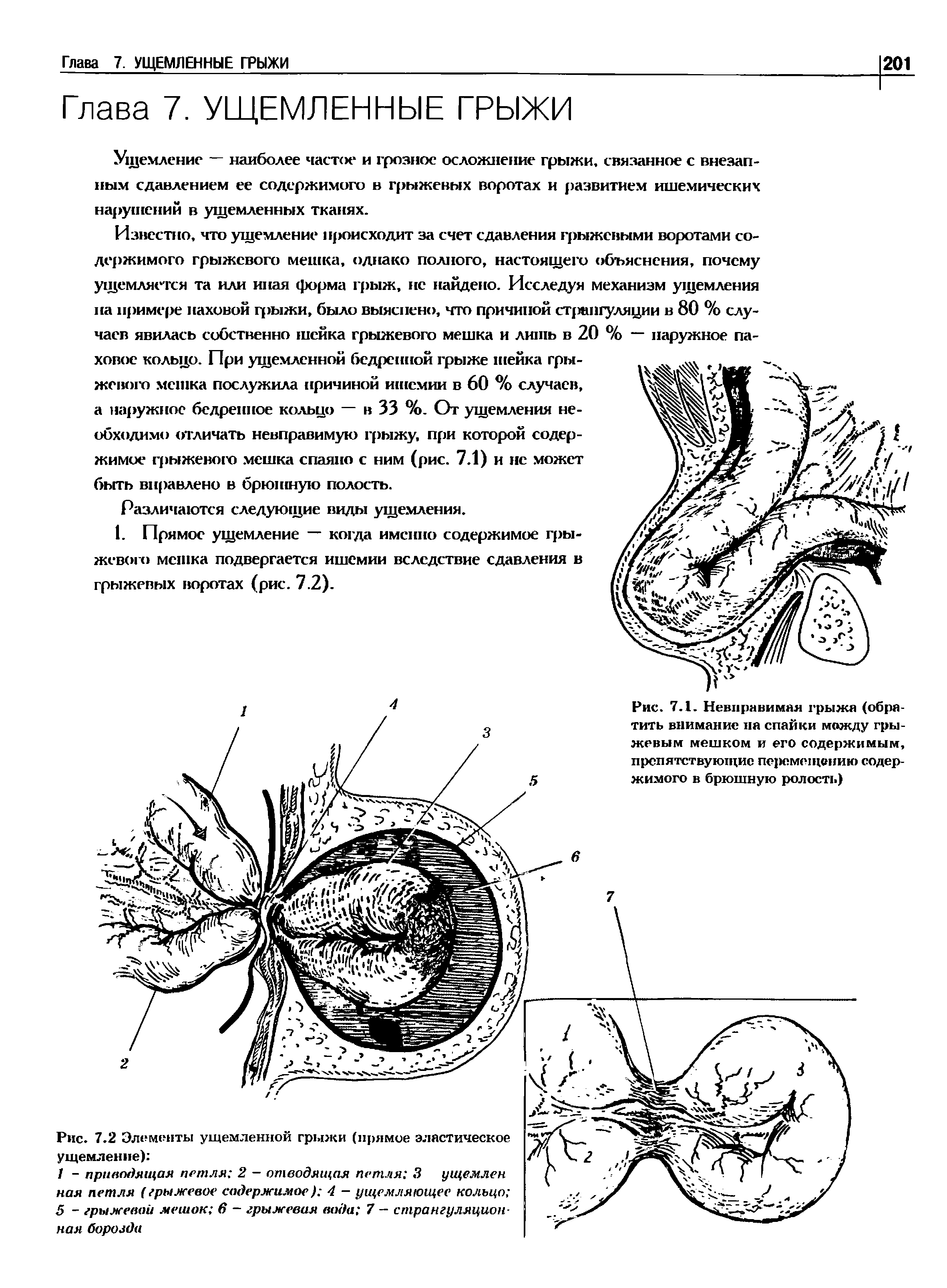 Рис. 7.2 Элементы ущемленной грыжи (прямое эластическое ущемление) ...