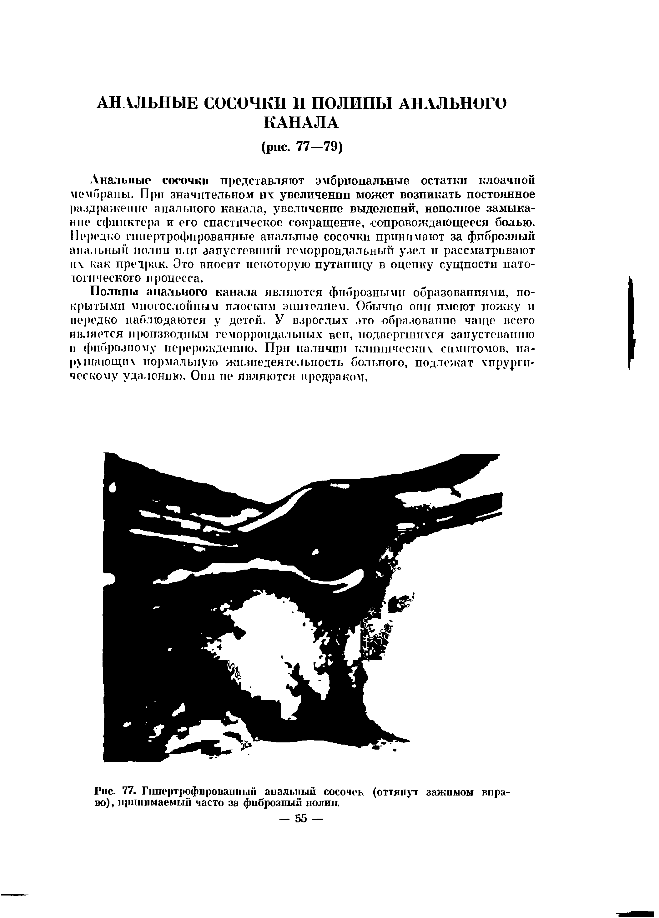 Рис. 77. Гипертрофированный анальный сосочек (оттянут зажимом вправо), принимаемый часто за фиброзный полип.