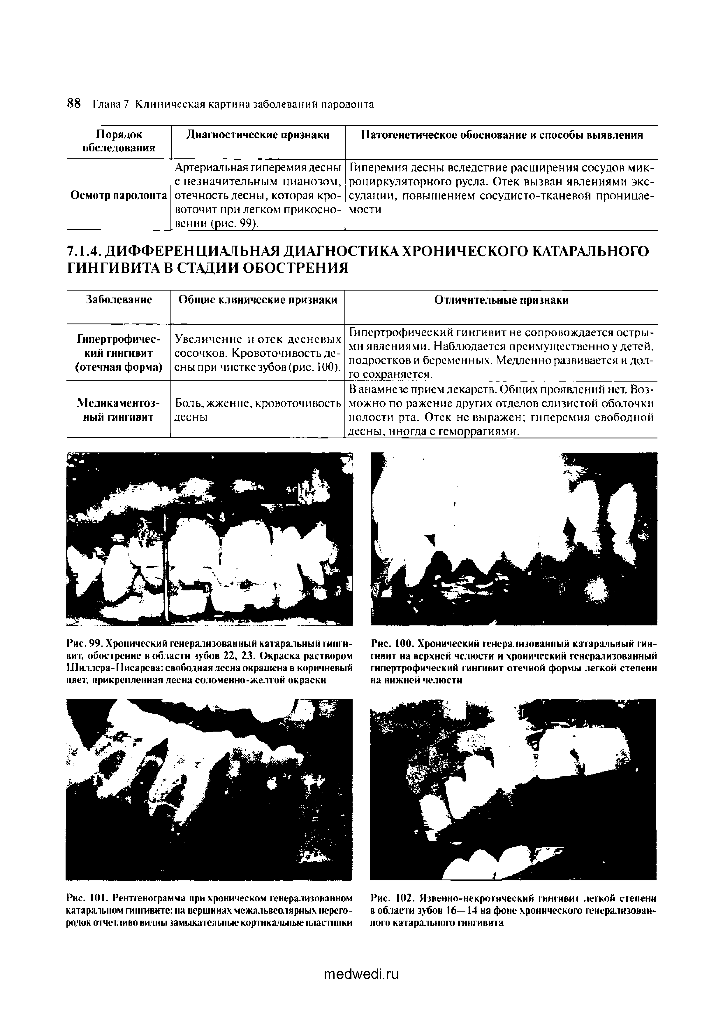 Рис. 100, Хронический генерализованный катаральный гингивит на верхней челюсти и хронический генерализованный гипертрофический гингивит отечной формы легкой степени на нижней челюсти...