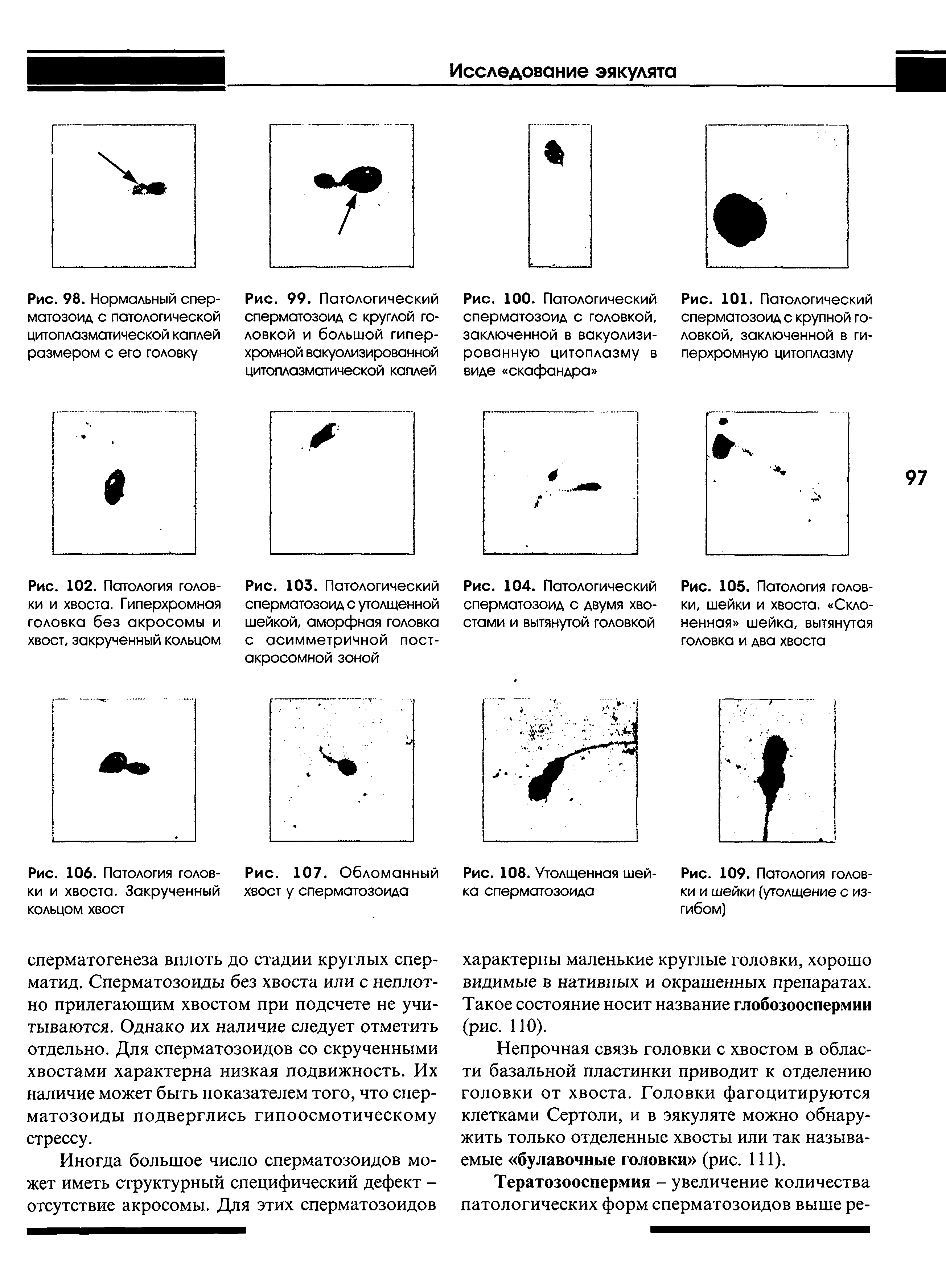 Рис. 102. Патология головки и хвоста. Гиперхромная головка без акросомы и хвост, закрученный кольцом...