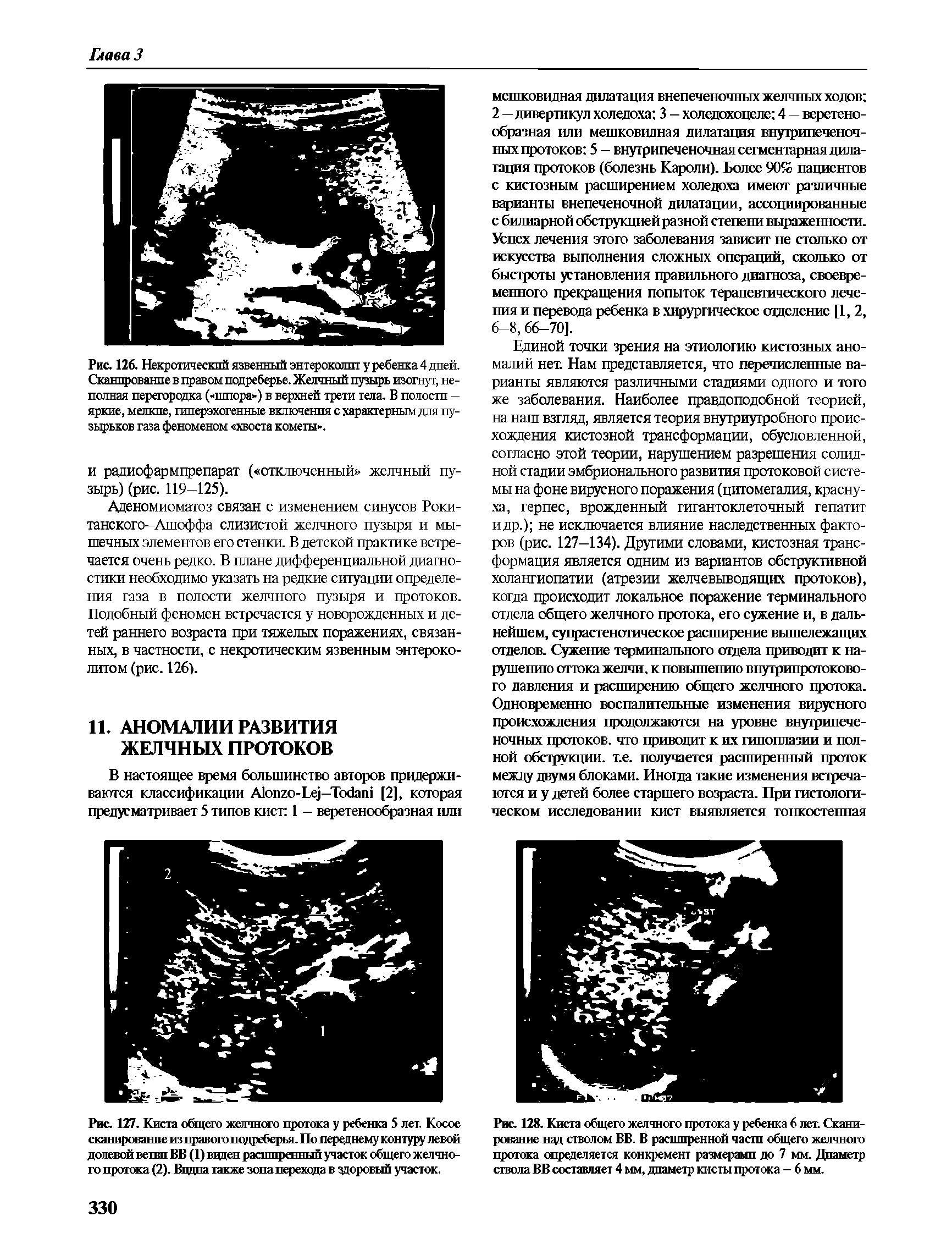 Рис. 126. Некротический язвенный энтероколиту ребенка 4 дней. Сканирование в правом подреберье. Желчный пузырь изогнут, неполная перегородка ( шпора ) в верхней трети тела. В полости -яркие, мелкие, гиперэхогенные включения с характерным для пузырьков газа феноменом хвоста кометы .